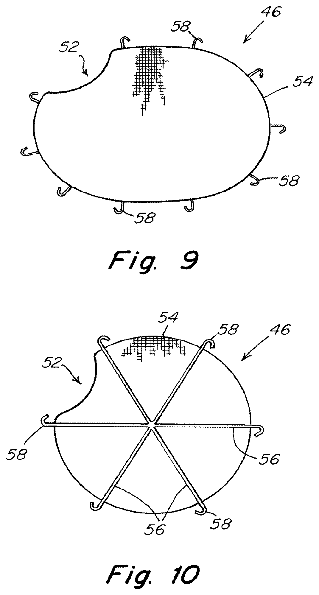 Patent US11771542 Figure 9 – Method and prosthesis for percutaneous hernia repair
