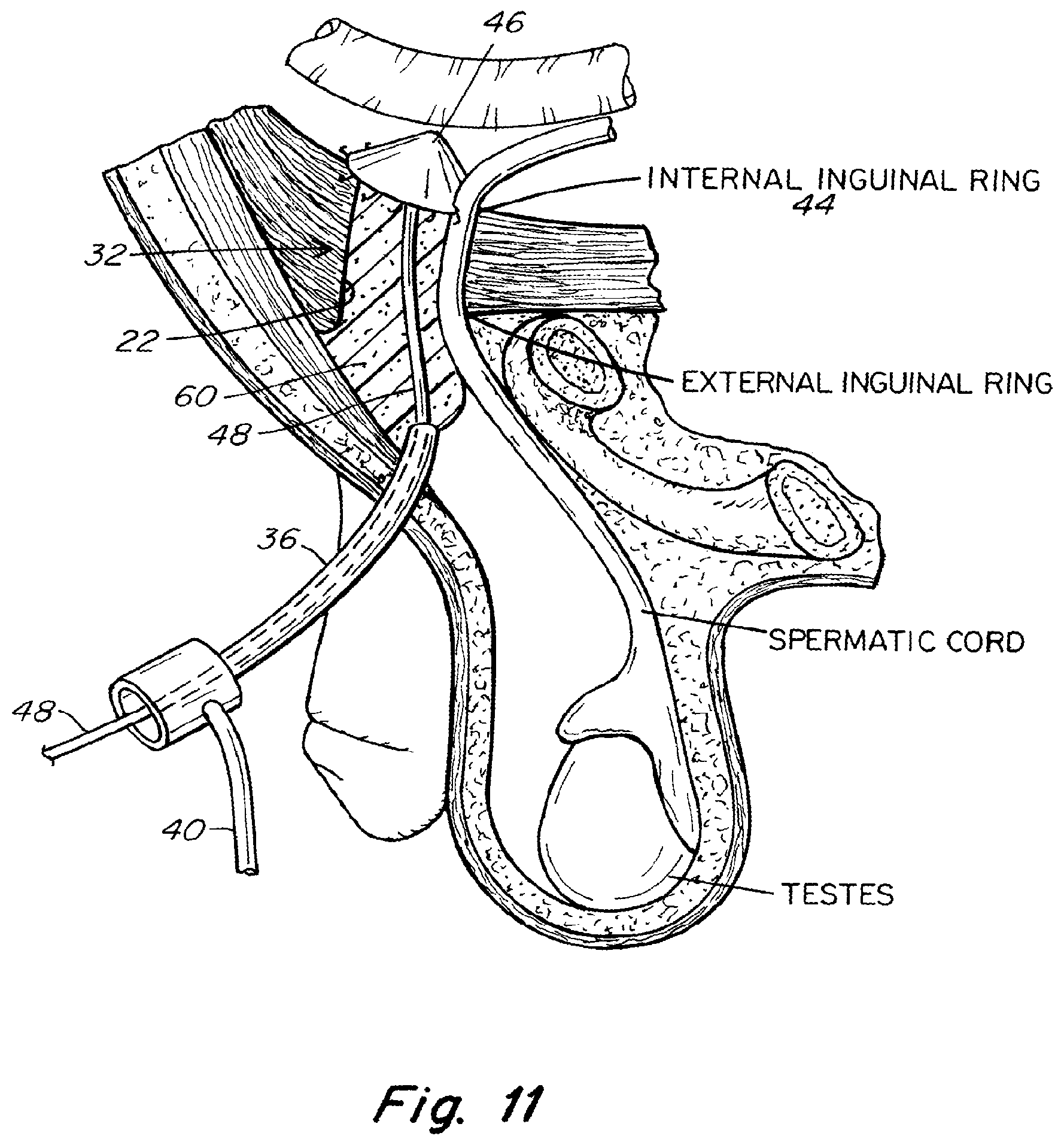Patent US11771542 Figure 10 – Method and prosthesis for percutaneous hernia repair