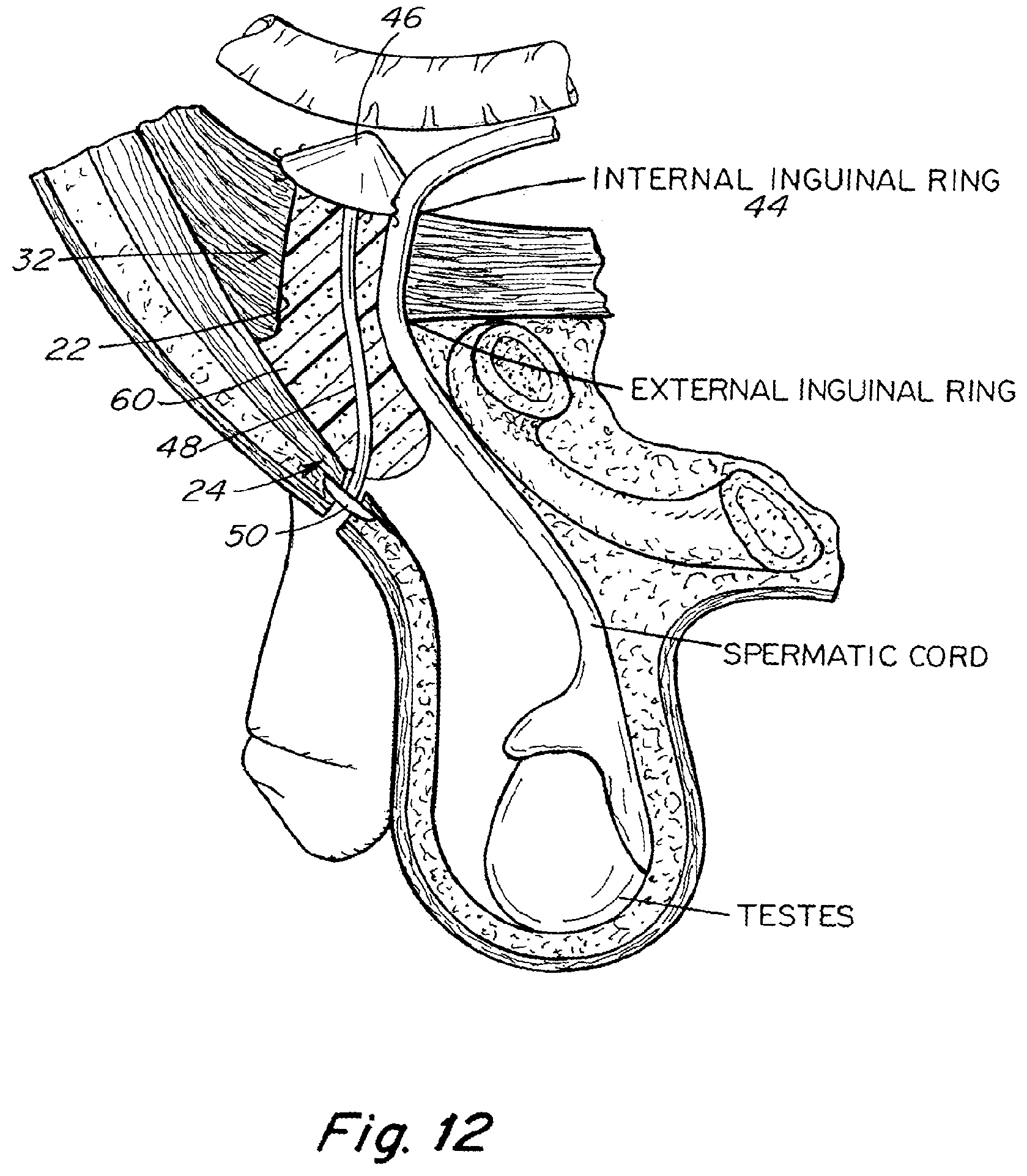 Patent US11771542 Figure 11 – Method and prosthesis for percutaneous hernia repair