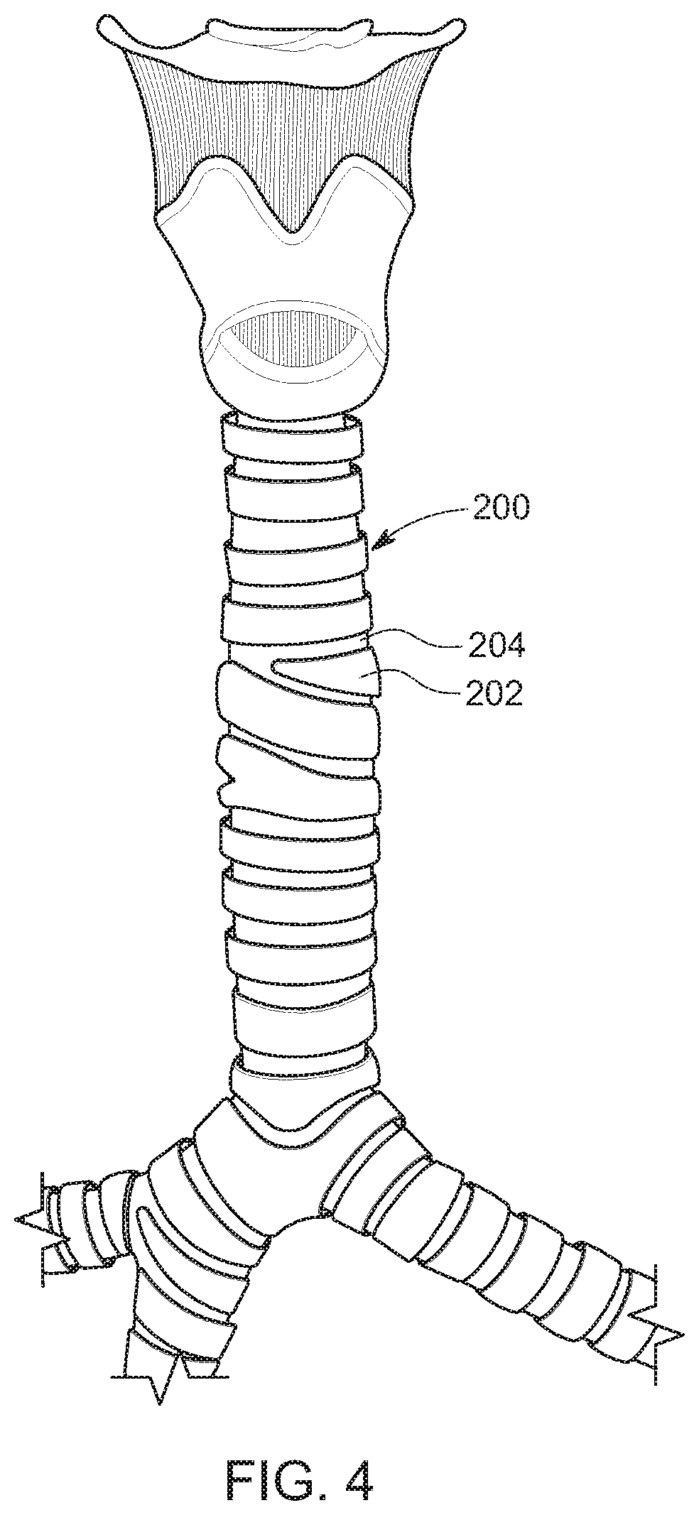 Patent US11771545 Figure 4 – Prosthesis for trachea