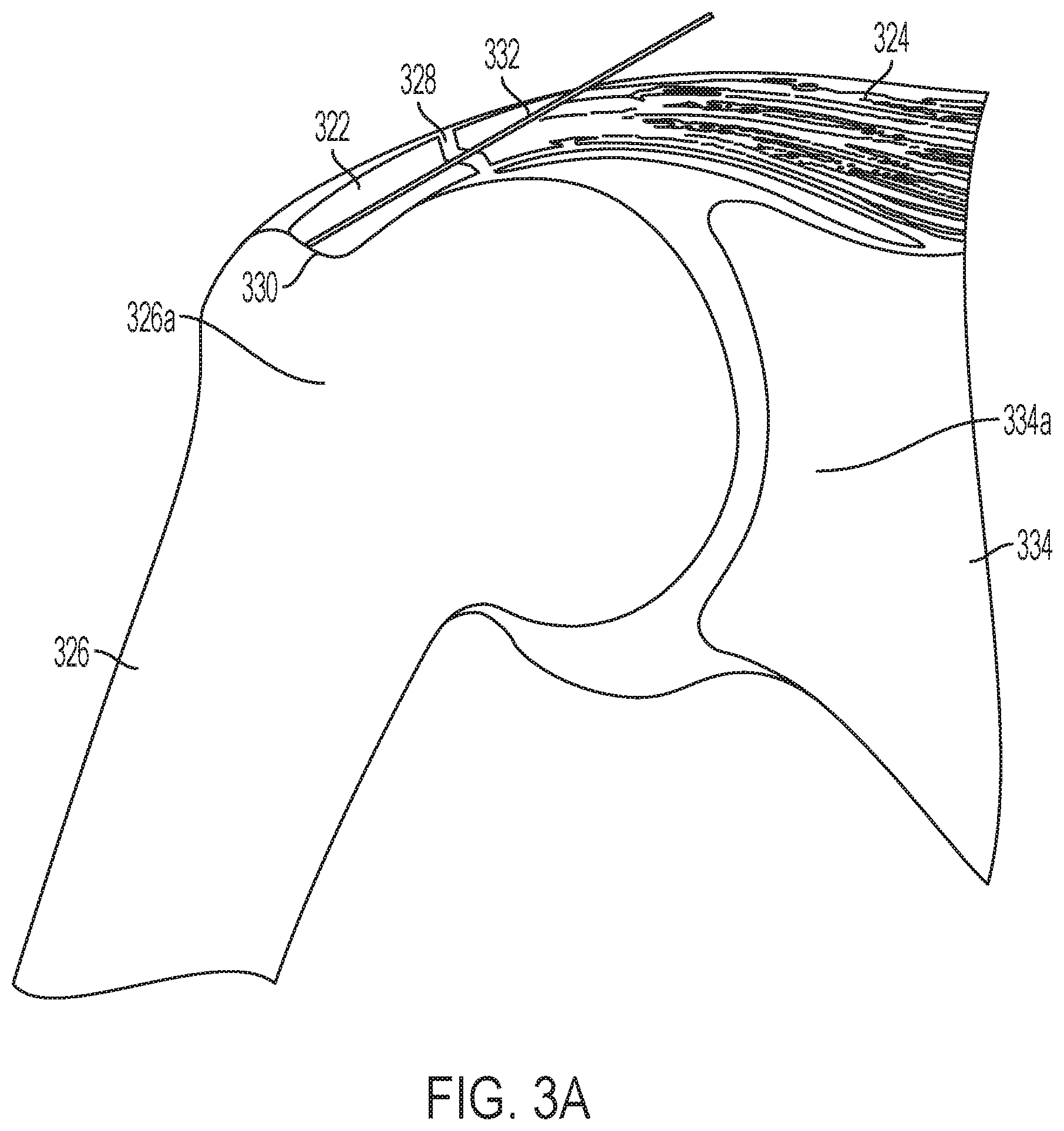 Patent US11771549 Figure 3 – Implantable articles for attaching tendons and/or ligaments to bone and/or cartilage, assemblies thereof, and methods of use thereof