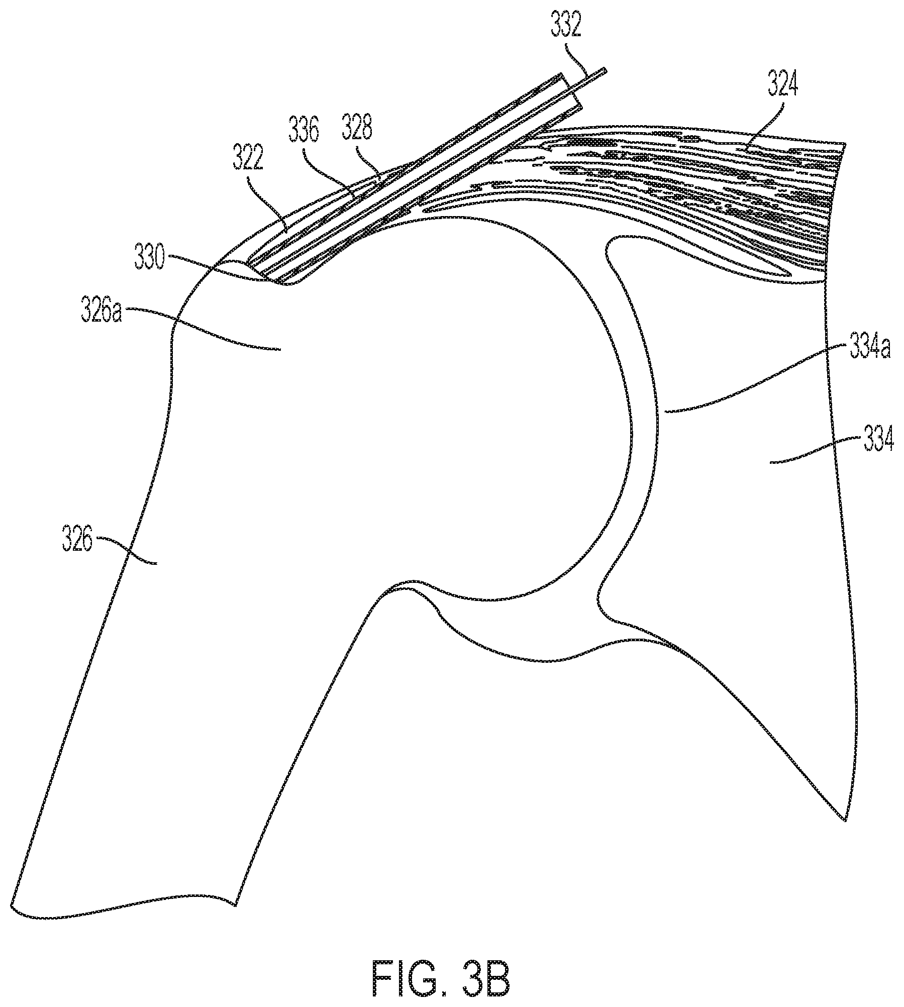 Patent US11771549 Figure 4 – Implantable articles for attaching tendons and/or ligaments to bone and/or cartilage, assemblies thereof, and methods of use thereof