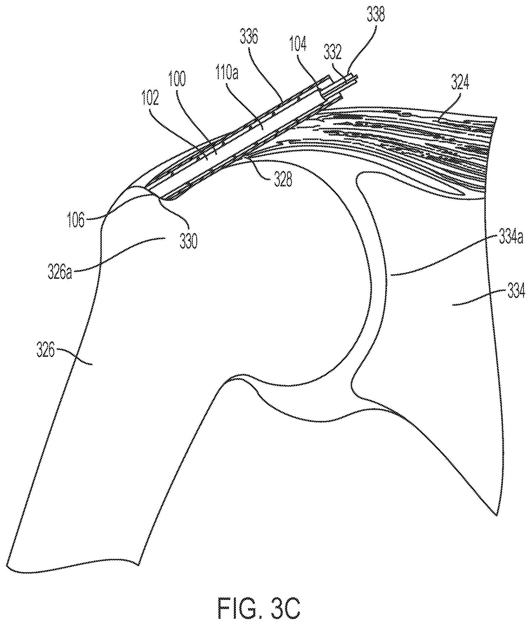 Patent US11771549 Figure 5 – Implantable articles for attaching tendons and/or ligaments to bone and/or cartilage, assemblies thereof, and methods of use thereof