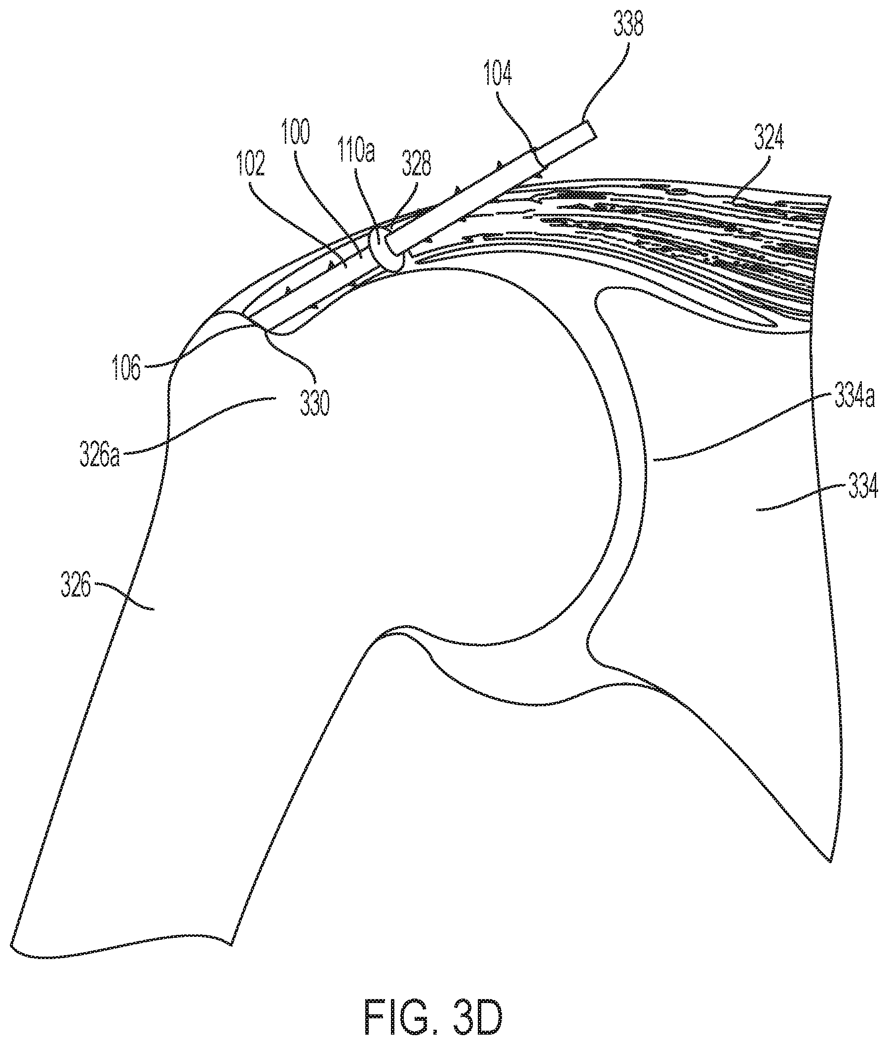 Patent US11771549 Figure 6 – Implantable articles for attaching tendons and/or ligaments to bone and/or cartilage, assemblies thereof, and methods of use thereof