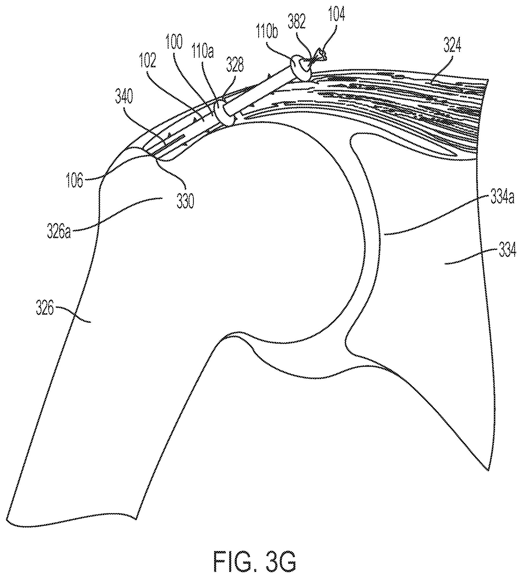 Patent US11771549 Figure 9 – Implantable articles for attaching tendons and/or ligaments to bone and/or cartilage, assemblies thereof, and methods of use thereof