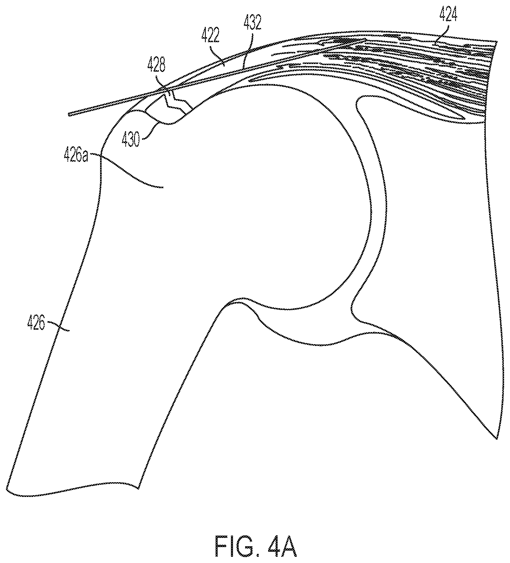 Patent US11771549 Figure 10 – Implantable articles for attaching tendons and/or ligaments to bone and/or cartilage, assemblies thereof, and methods of use thereof