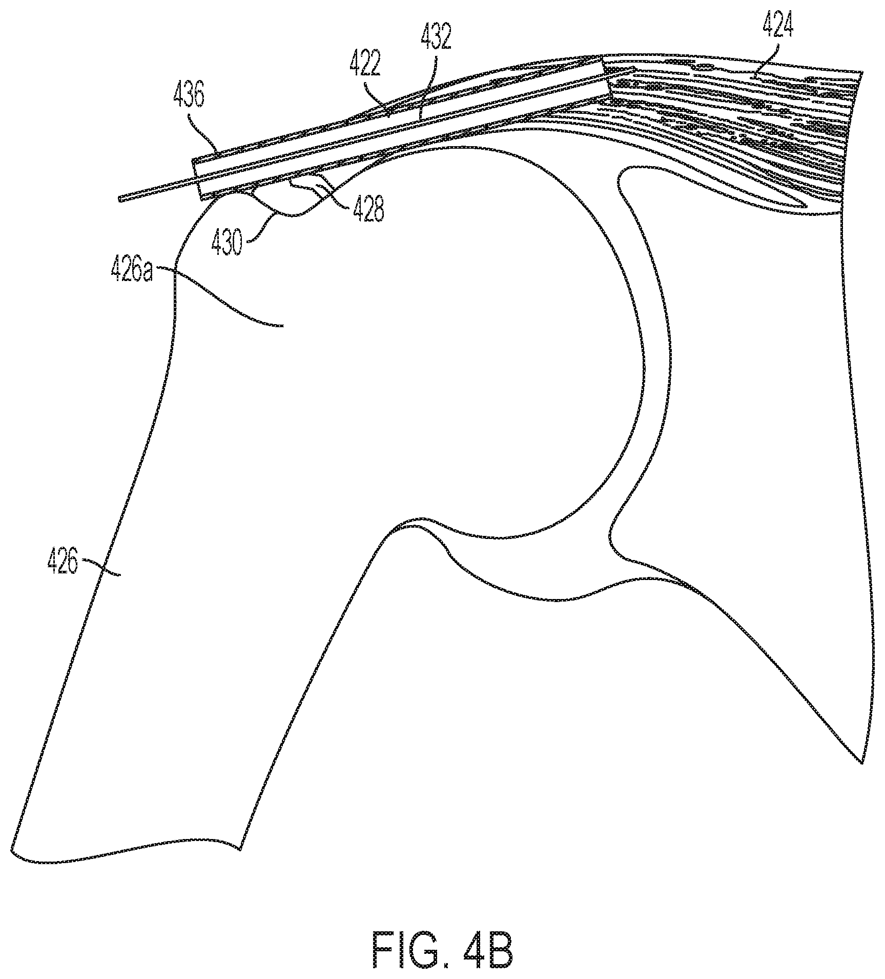 Patent US11771549 Figure 11 – Implantable articles for attaching tendons and/or ligaments to bone and/or cartilage, assemblies thereof, and methods of use thereof