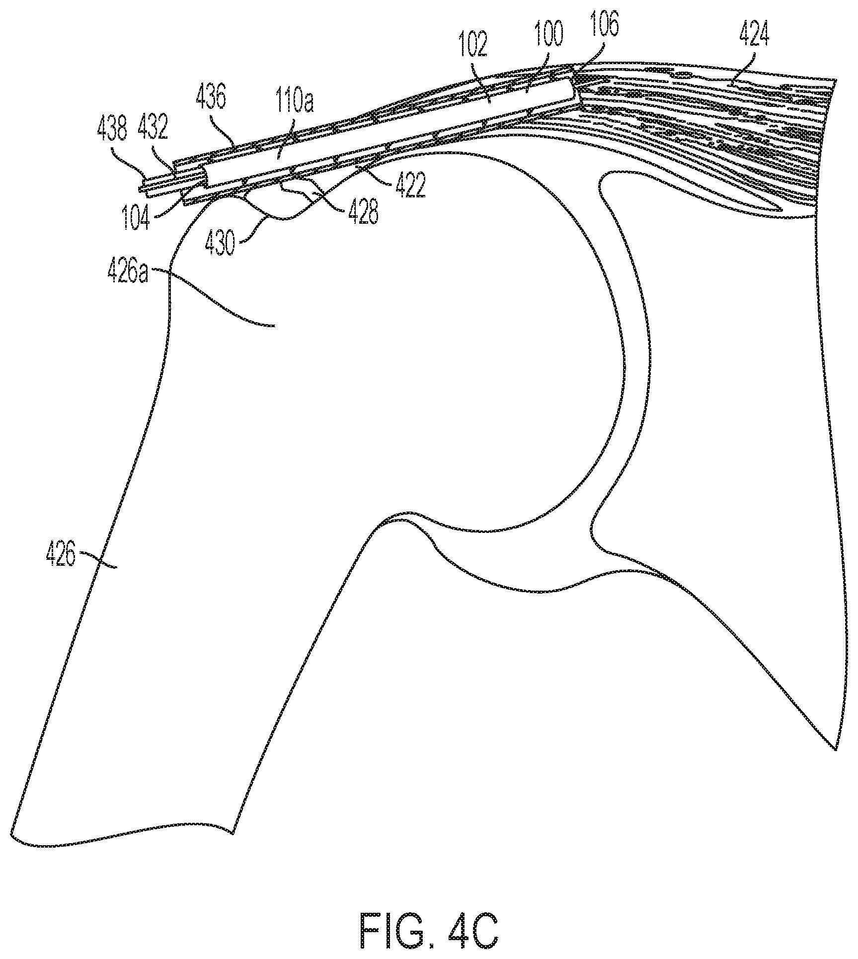 Patent US11771549 Figure 12 – Implantable articles for attaching tendons and/or ligaments to bone and/or cartilage, assemblies thereof, and methods of use thereof