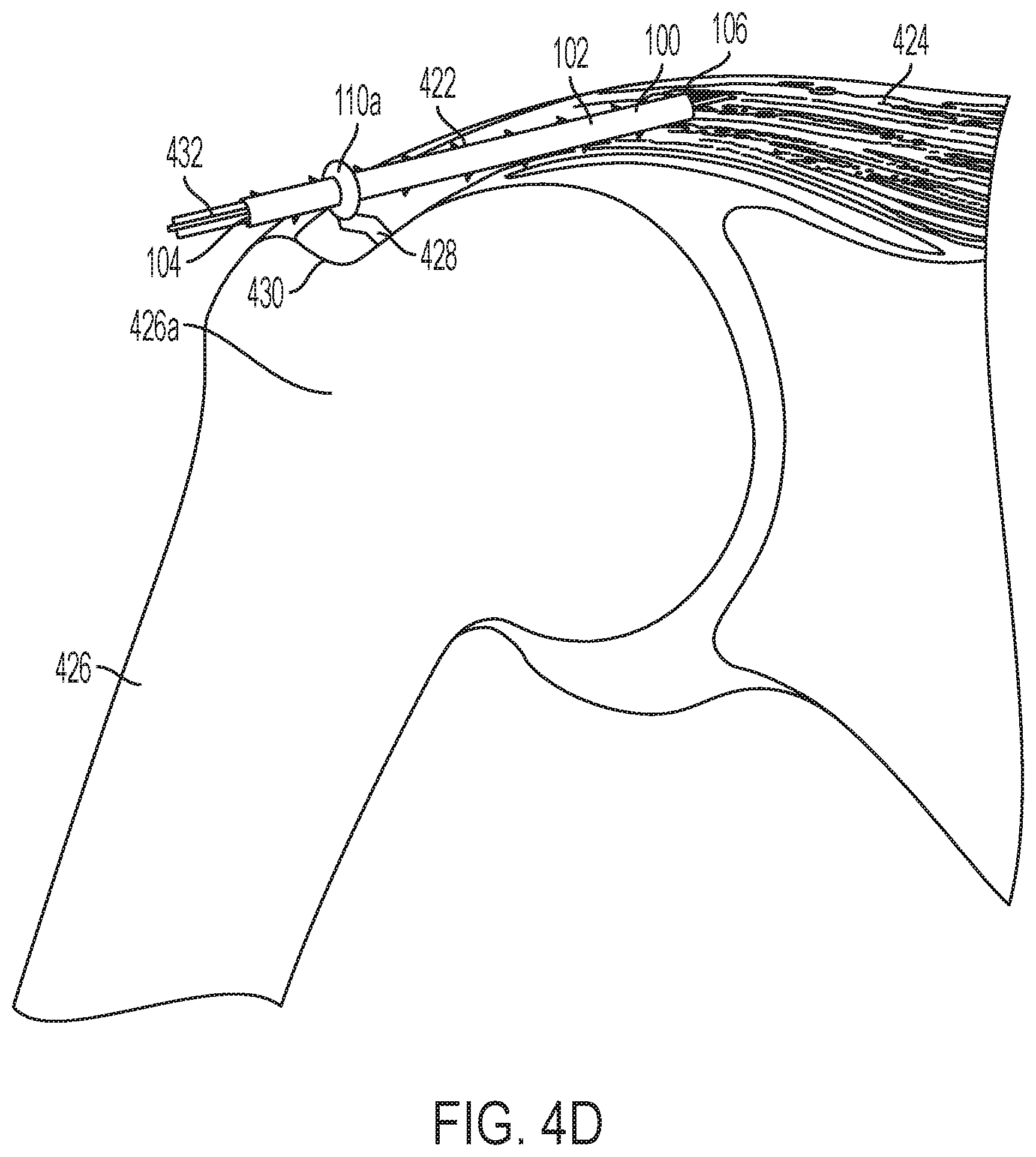 Patent US11771549 Figure 13 – Implantable articles for attaching tendons and/or ligaments to bone and/or cartilage, assemblies thereof, and methods of use thereof