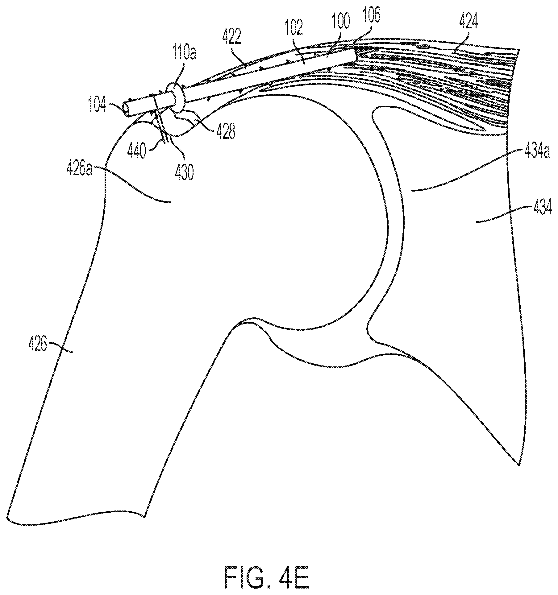 Patent US11771549 Figure 14 – Implantable articles for attaching tendons and/or ligaments to bone and/or cartilage, assemblies thereof, and methods of use thereof