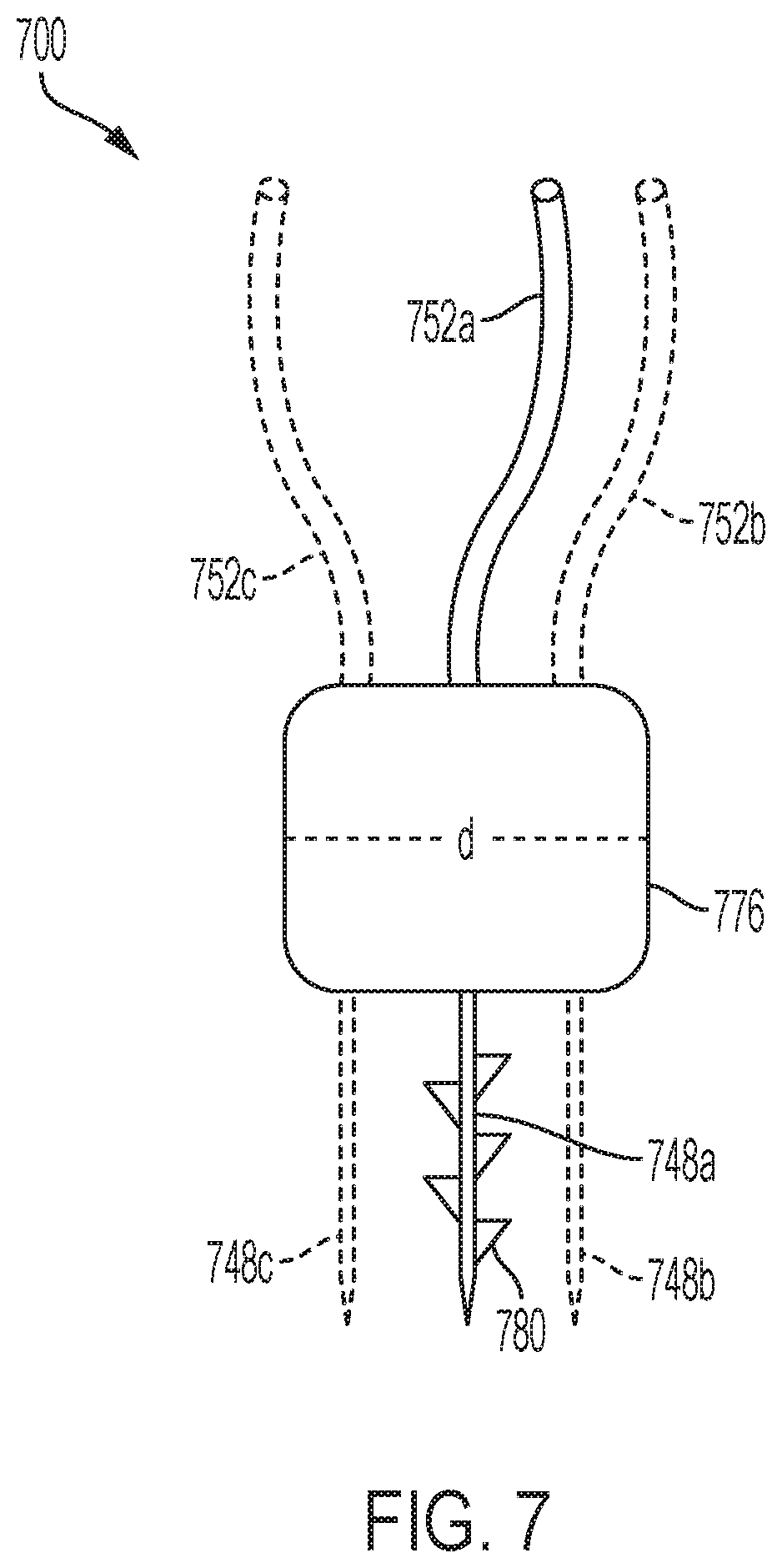 Patent US11771549 Figure 17 – Implantable articles for attaching tendons and/or ligaments to bone and/or cartilage, assemblies thereof, and methods of use thereof