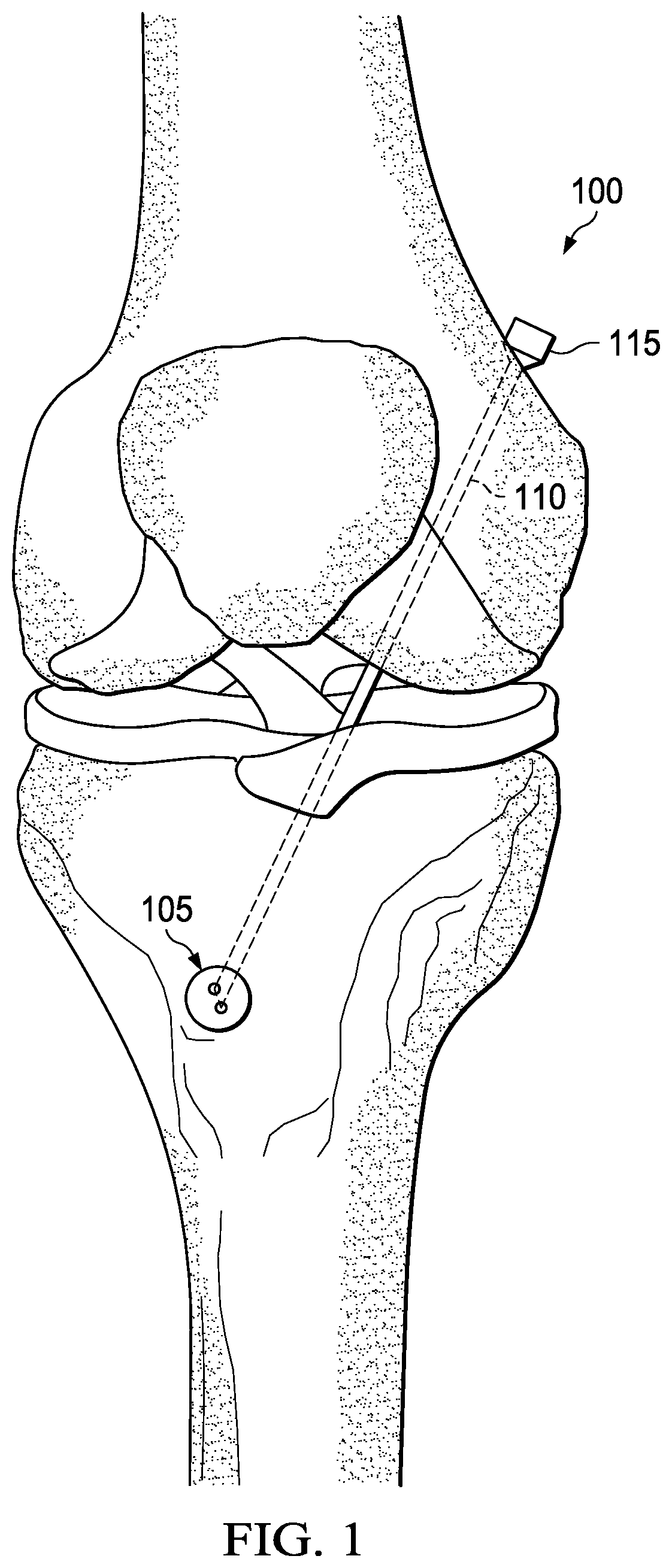 Patent US11771550 Figure 1 – Safe-release bone fastener for use with a ligament augmentation strap