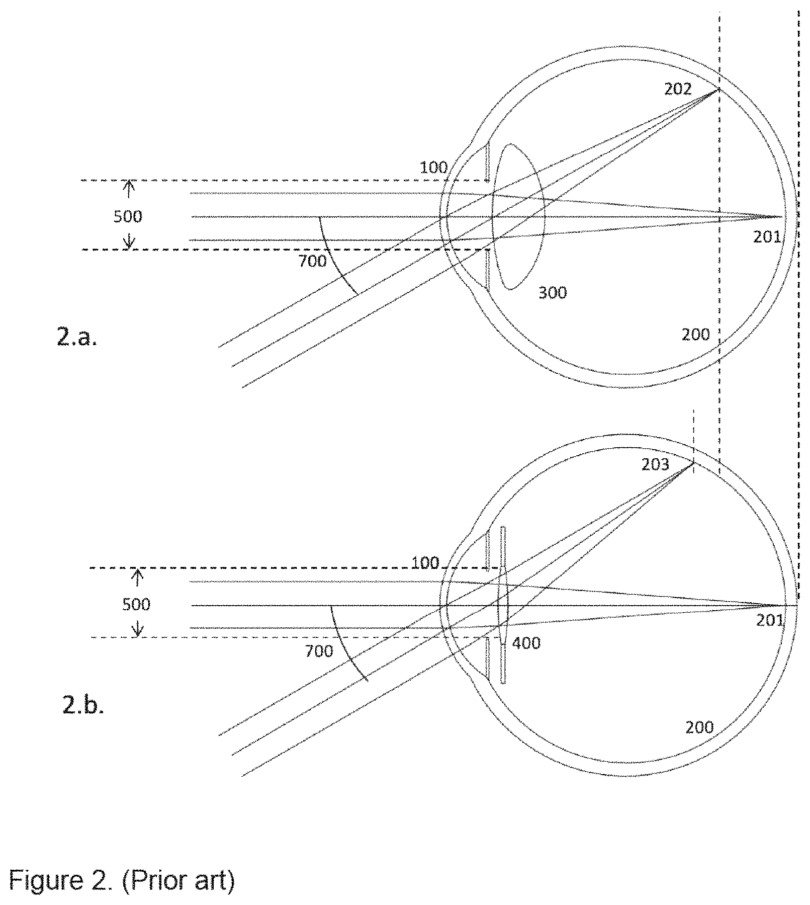 Patent US11771551 Figure 2 – Method to design and manufacture an intraocular lens