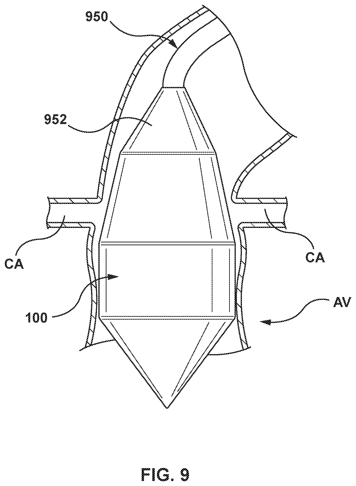 Patent US11771554 Figure 8 – Supra annular tapered balloon expandable stent for transcatheter implantation of a cardiac valve prosthesis