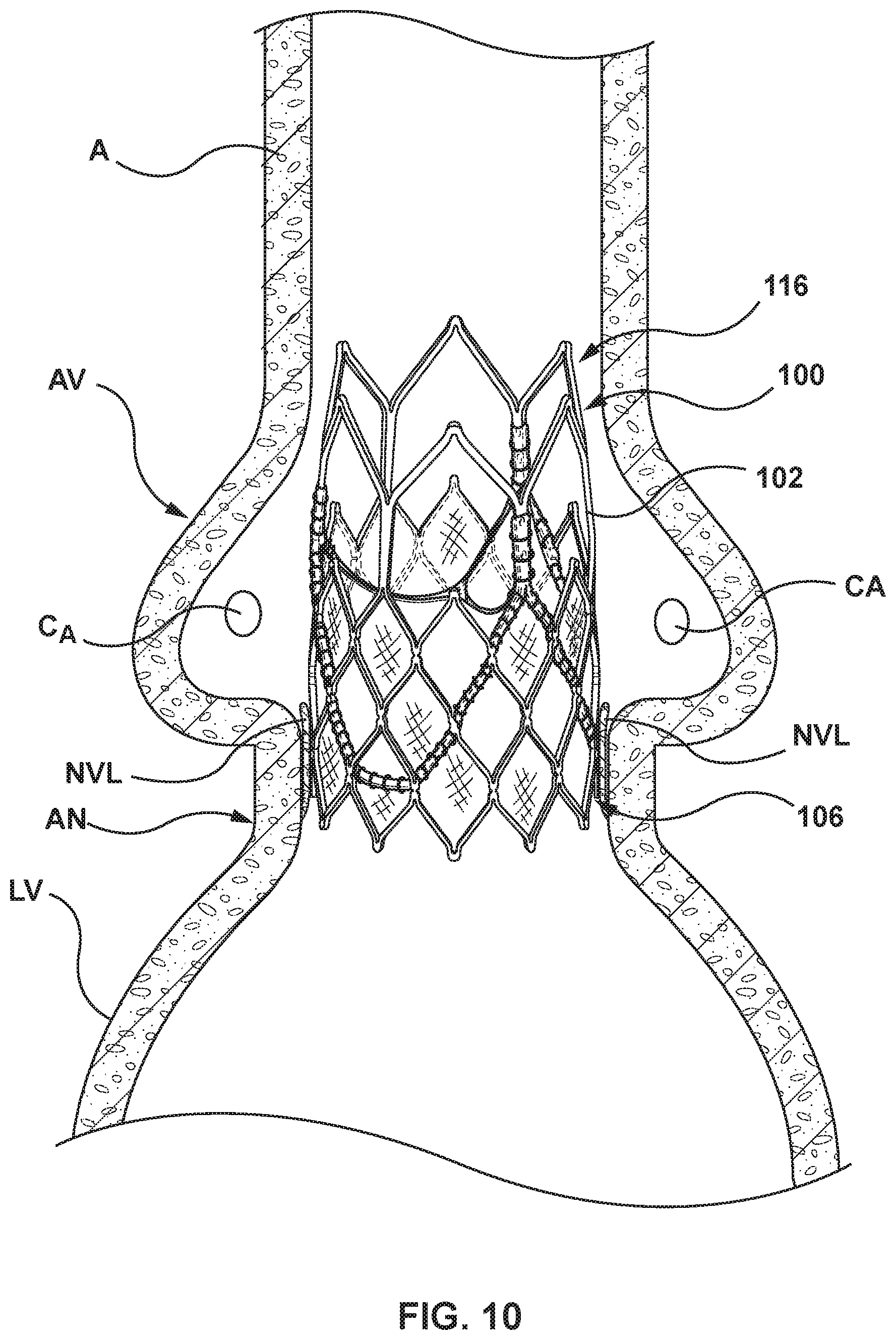 Patent US11771554 Figure 9 – Supra annular tapered balloon expandable stent for transcatheter implantation of a cardiac valve prosthesis