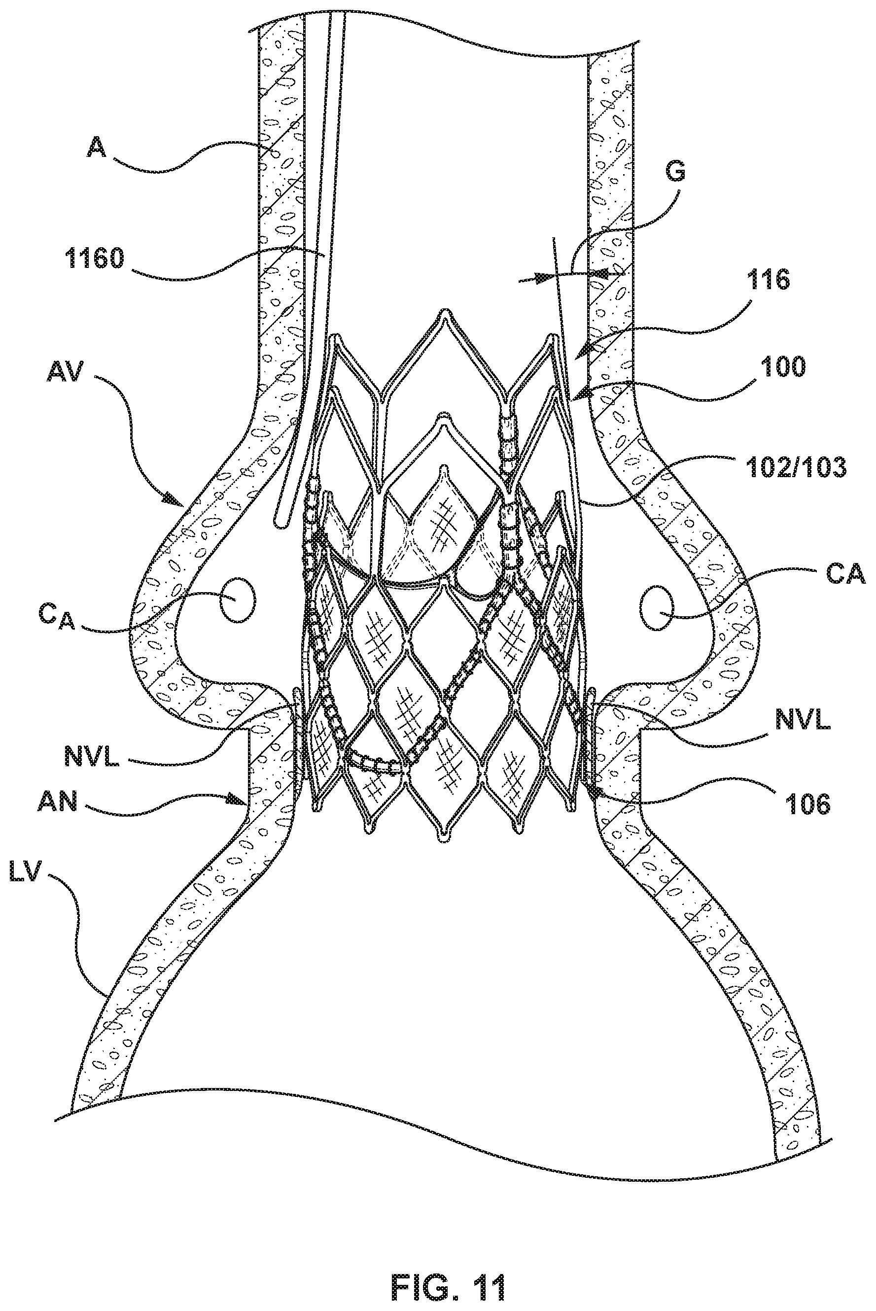 Patent US11771554 Figure 10 – Supra annular tapered balloon expandable stent for transcatheter implantation of a cardiac valve prosthesis