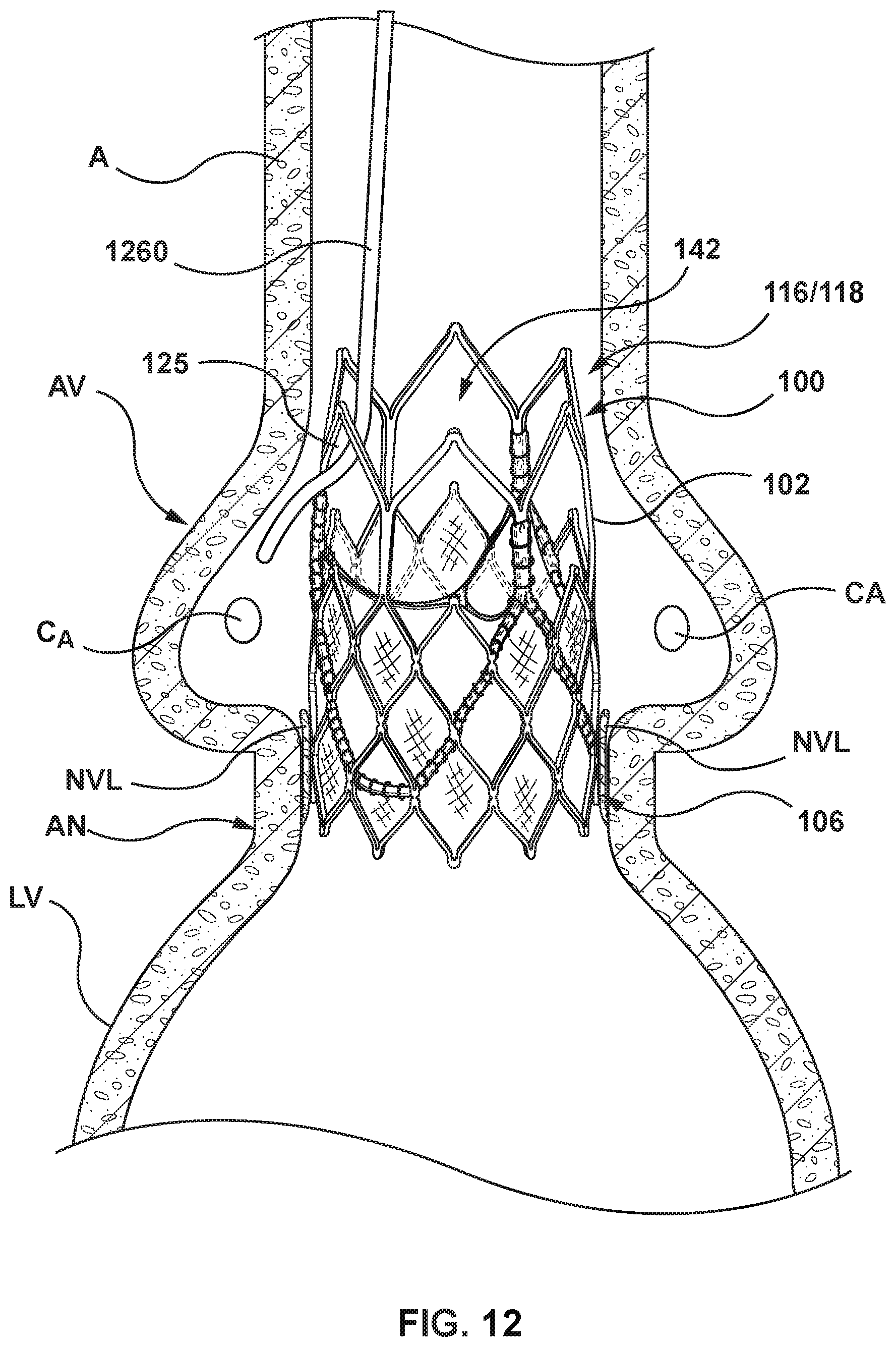 Patent US11771554 Figure 11 – Supra annular tapered balloon expandable stent for transcatheter implantation of a cardiac valve prosthesis