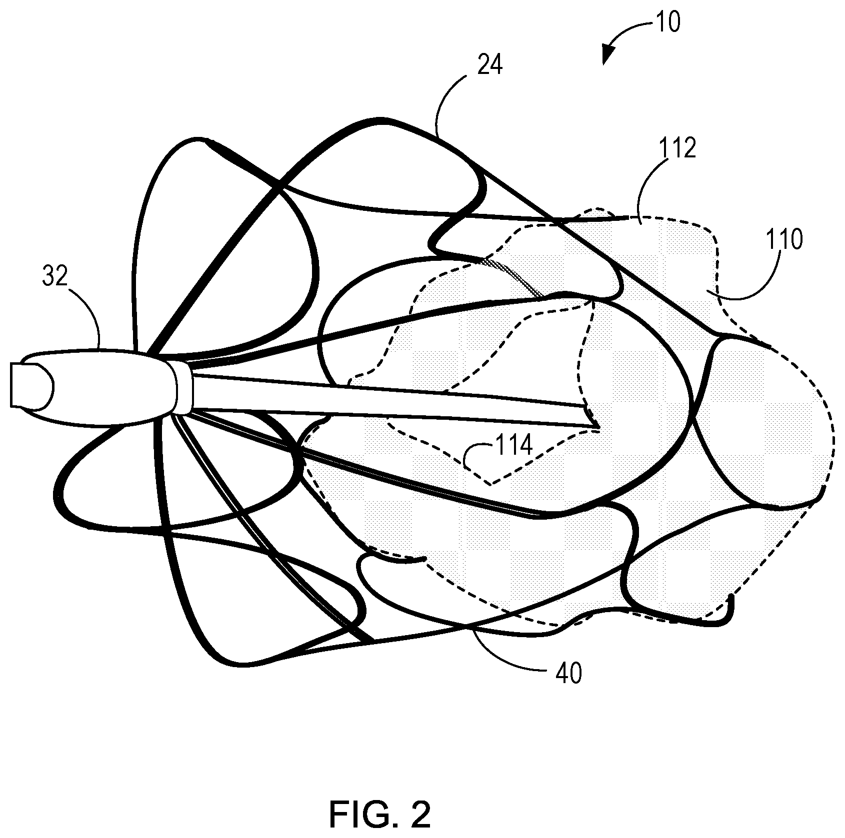 Patent US11771555 Figure 3 – Retrievable self-expanding non-thrombogenic low-profile percutaneous atrioventricular valve prosthesis