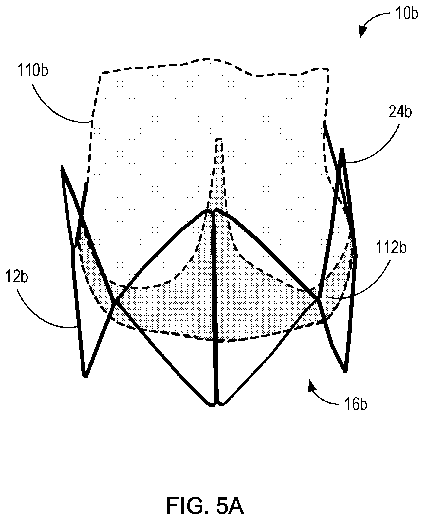 Patent US11771555 Figure 6 – Retrievable self-expanding non-thrombogenic low-profile percutaneous atrioventricular valve prosthesis