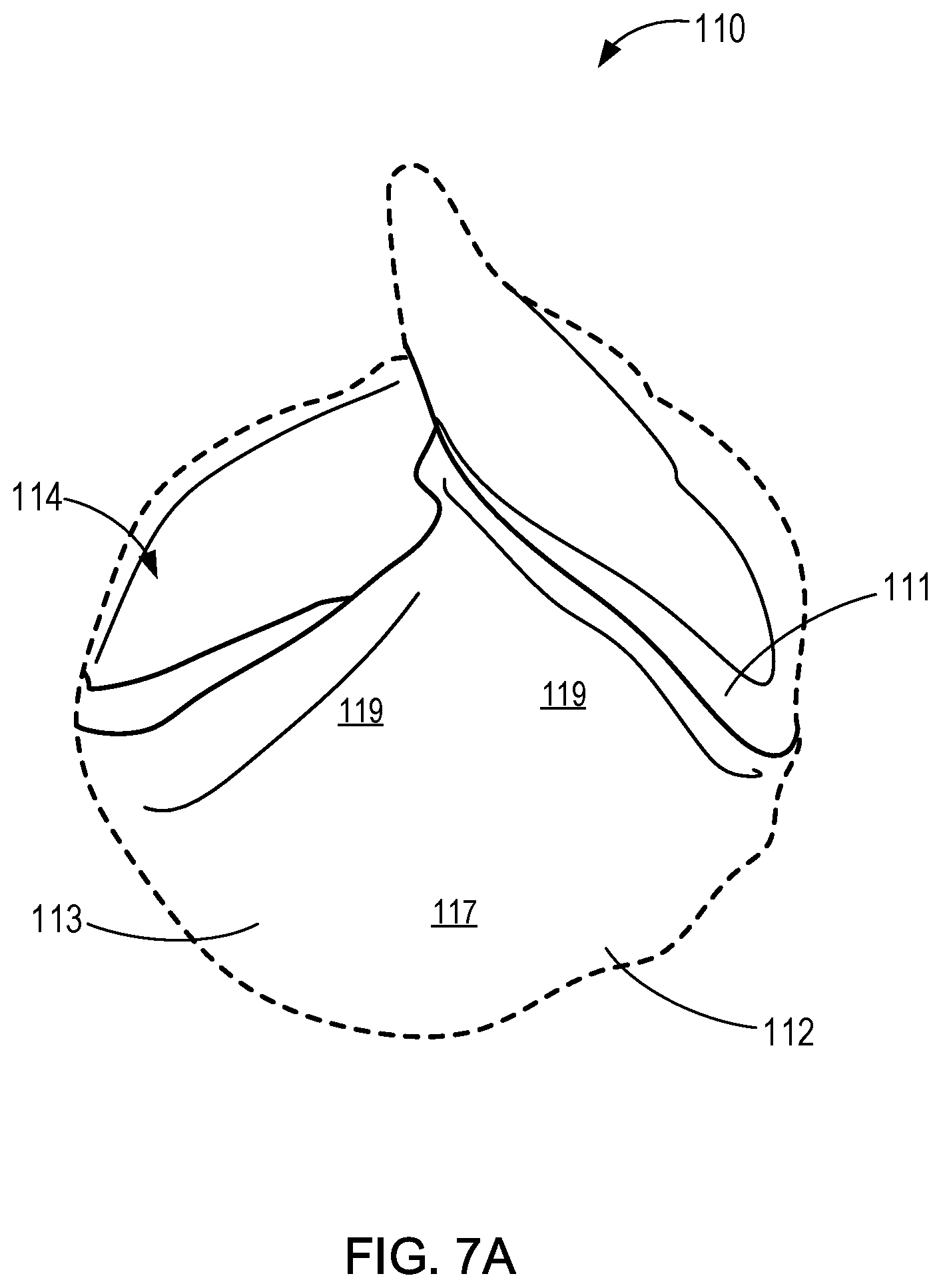 Patent US11771555 Figure 10 – Retrievable self-expanding non-thrombogenic low-profile percutaneous atrioventricular valve prosthesis