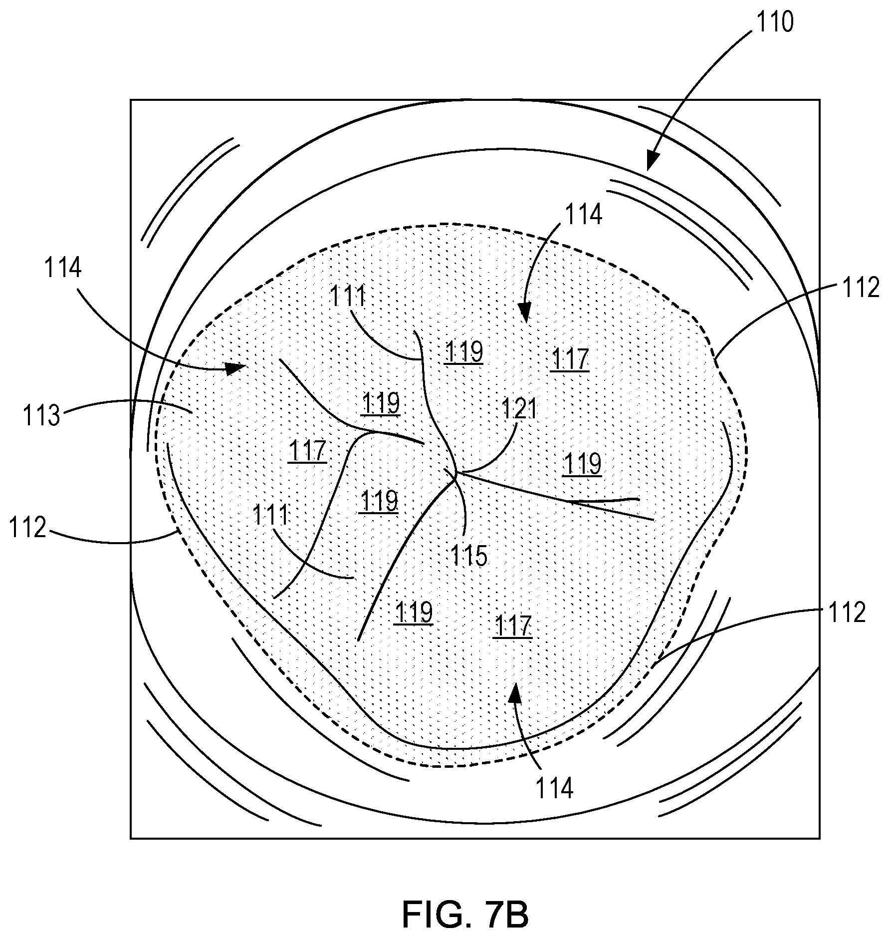 Patent US11771555 Figure 11 – Retrievable self-expanding non-thrombogenic low-profile percutaneous atrioventricular valve prosthesis