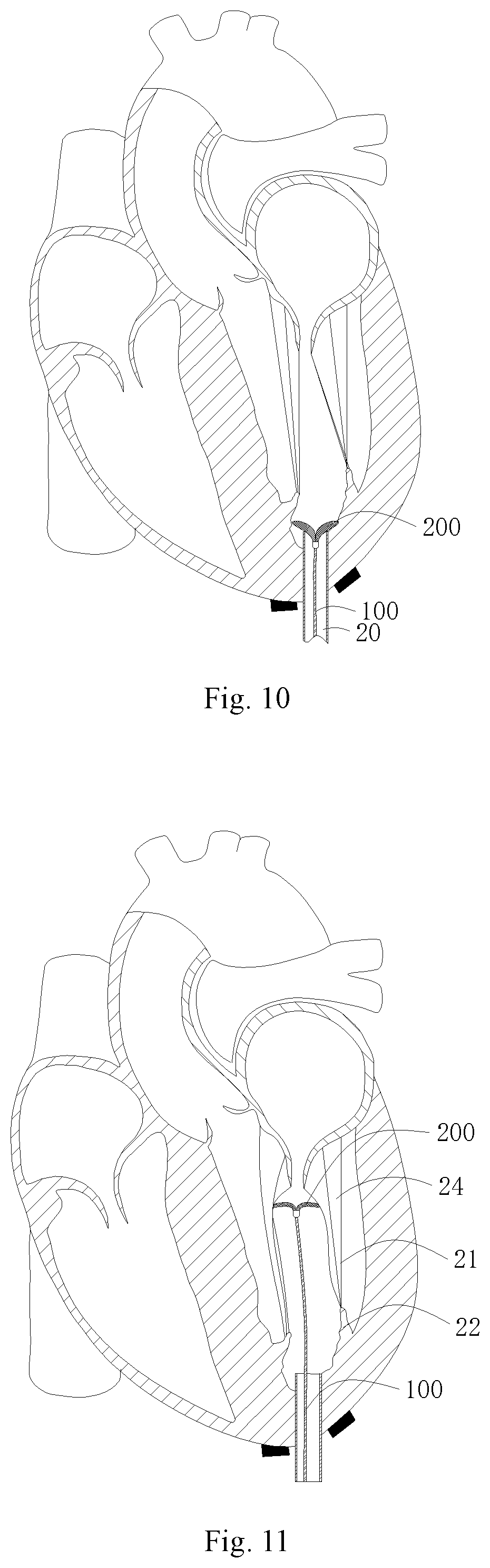 Patent US11771556 Figure 6 – Intervention guidance device