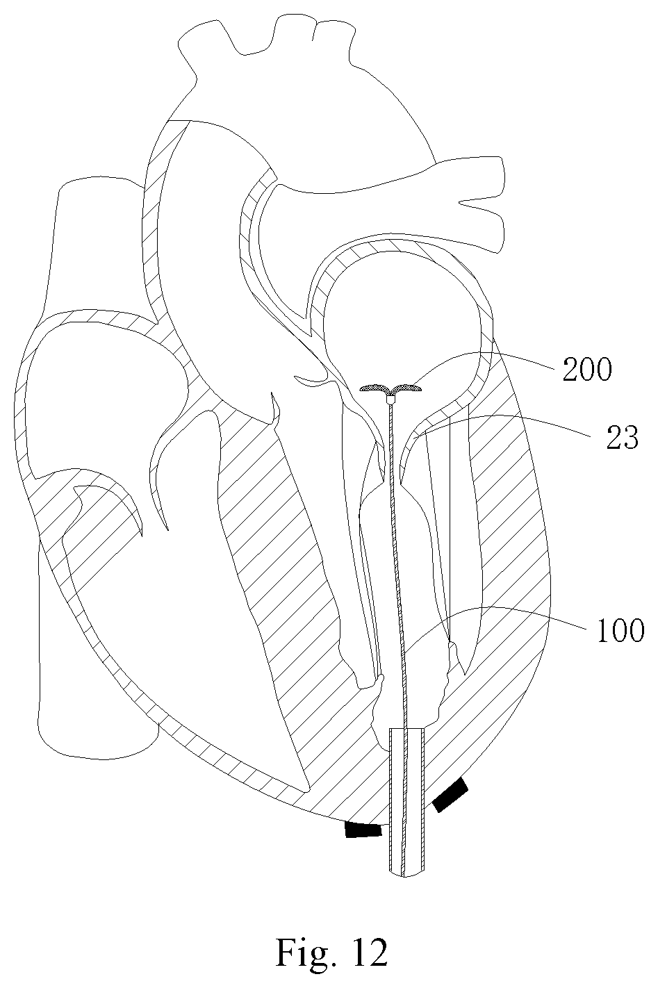 Patent US11771556 Figure 7 – Intervention guidance device