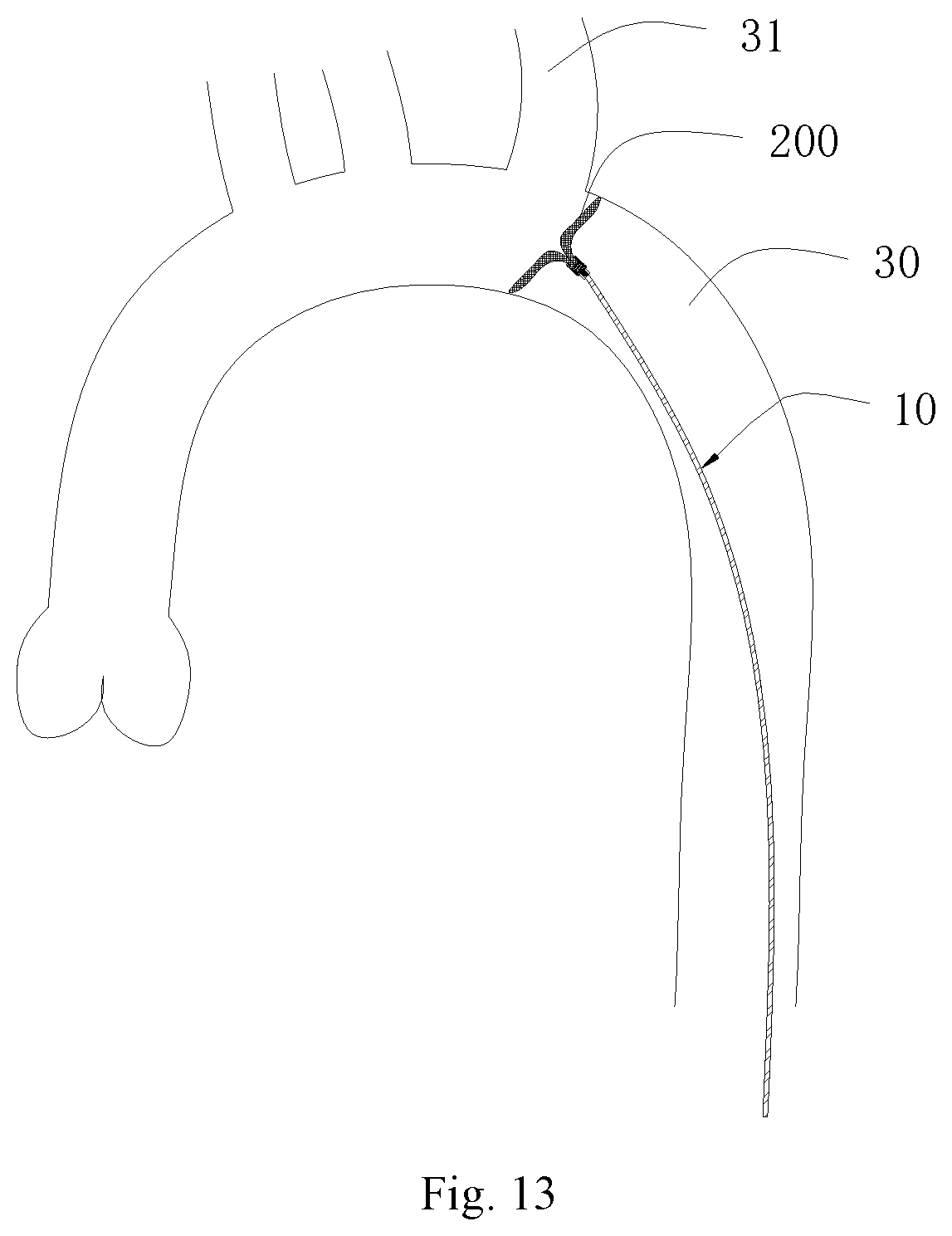 Patent US11771556 Figure 8 – Intervention guidance device