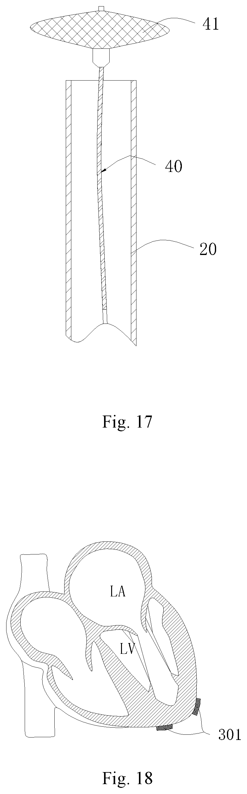 Patent US11771556 Figure 11 – Intervention guidance device