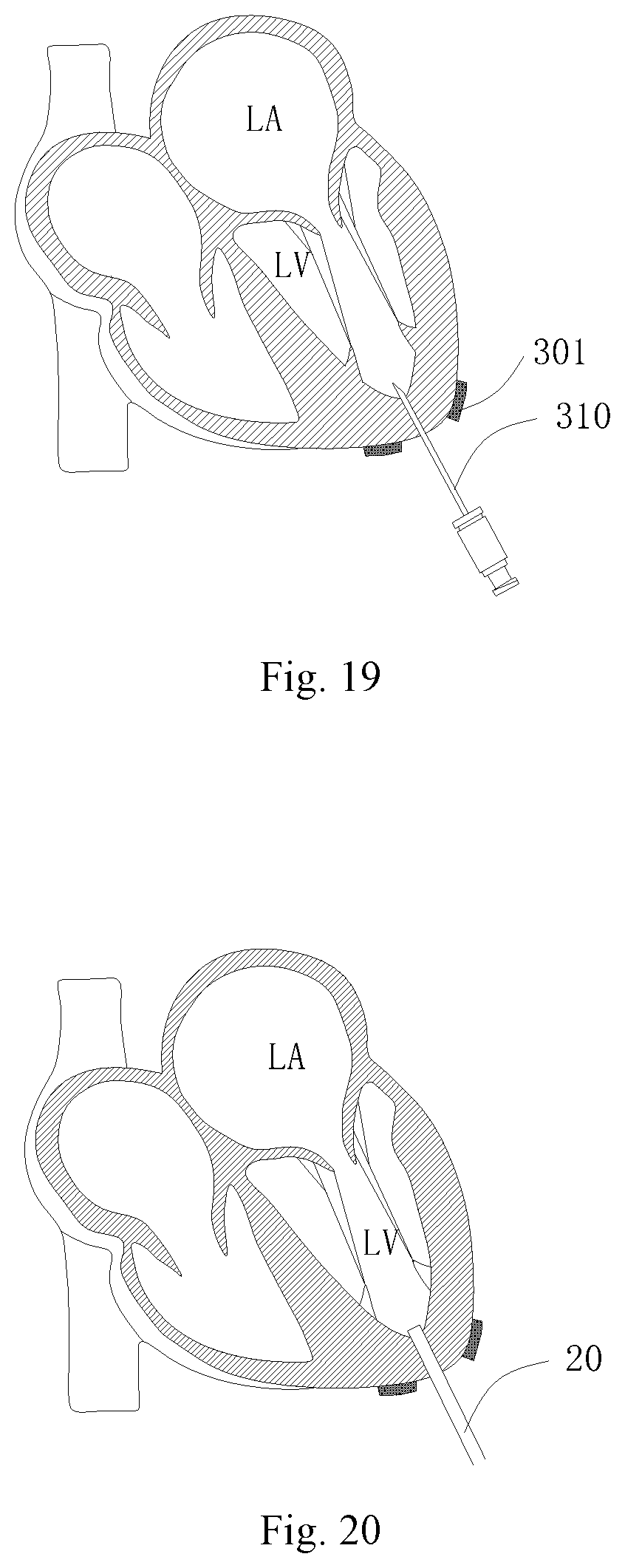 Patent US11771556 Figure 12 – Intervention guidance device