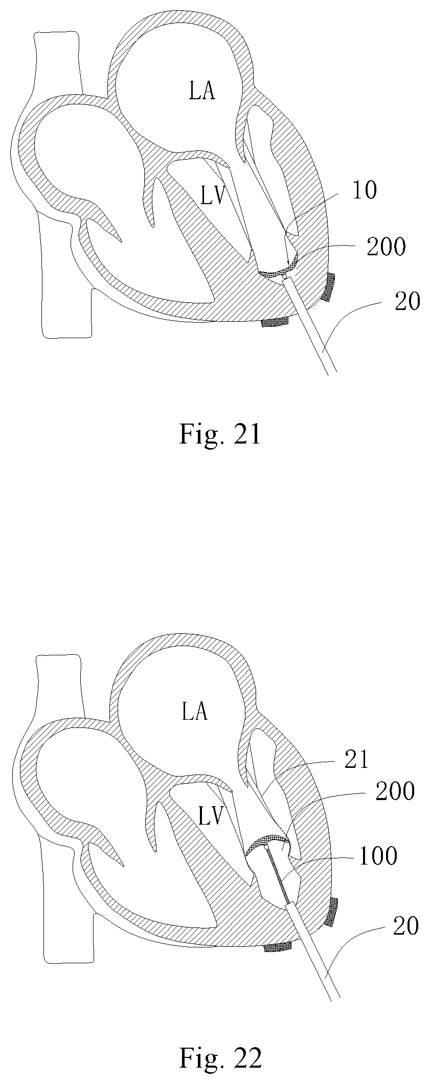 Patent US11771556 Figure 13 – Intervention guidance device