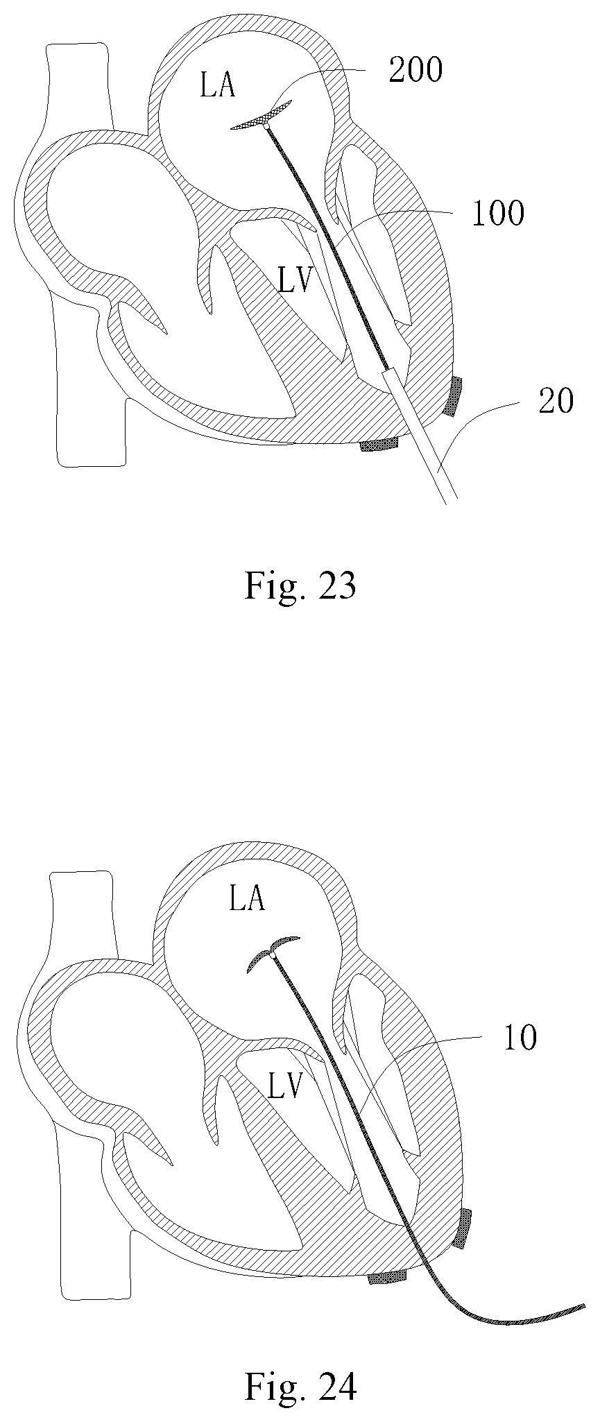 Patent US11771556 Figure 14 – Intervention guidance device