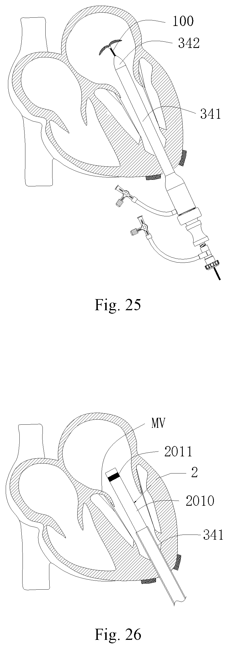 Patent US11771556 Figure 15 – Intervention guidance device