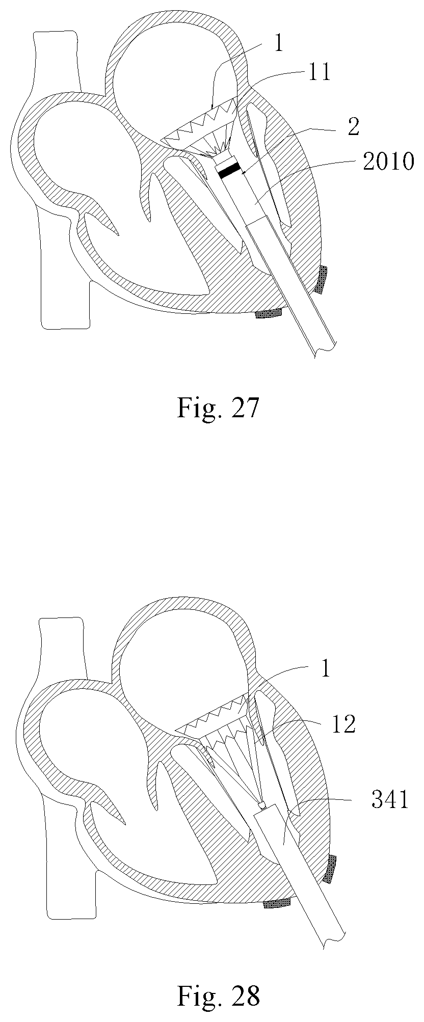 Patent US11771556 Figure 16 – Intervention guidance device