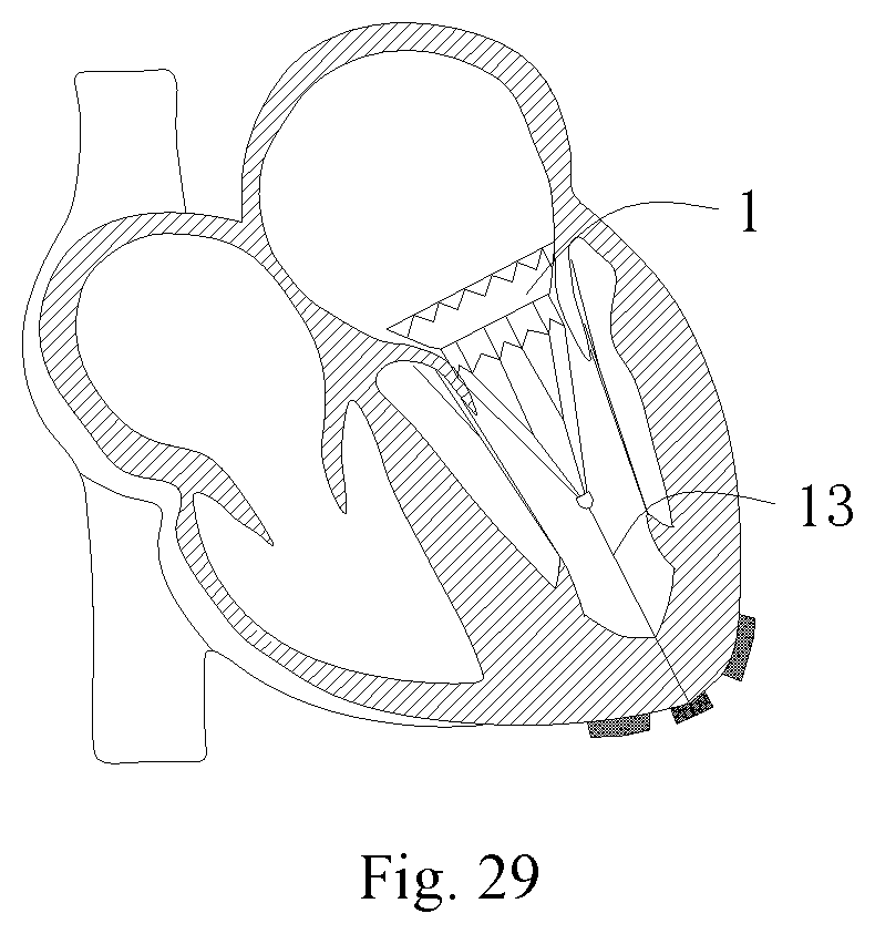 Patent US11771556 Figure 17 – Intervention guidance device