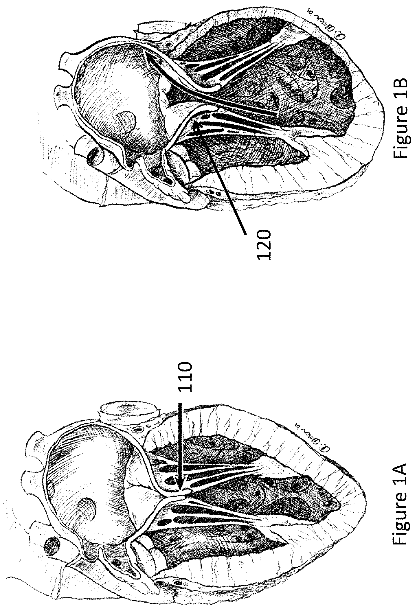 Patent US11771557 Figure 1 – Apparatus and method to reshape geometry of diseased heart valve