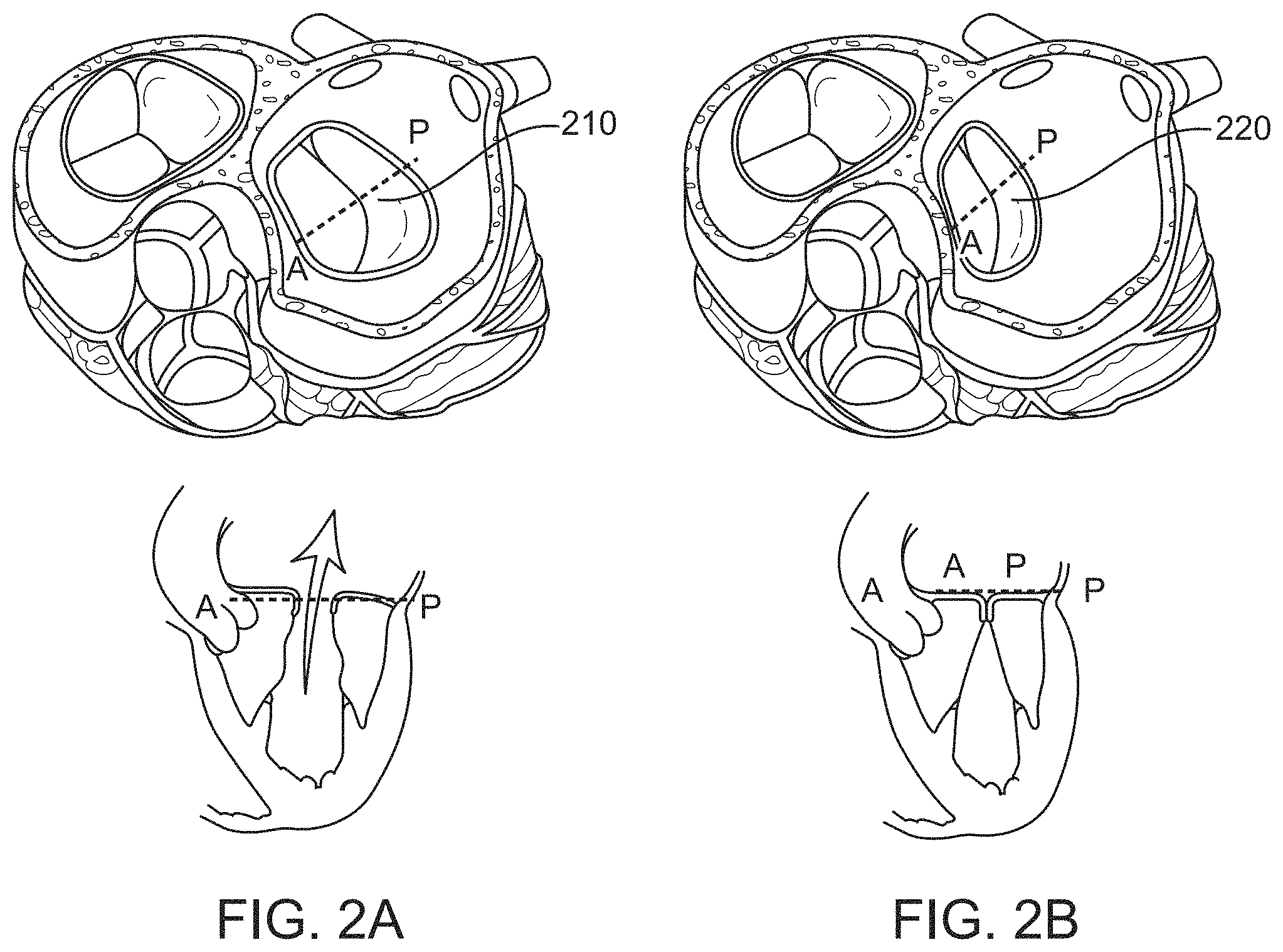 Patent US11771557 Figure 2 – Apparatus and method to reshape geometry of diseased heart valve