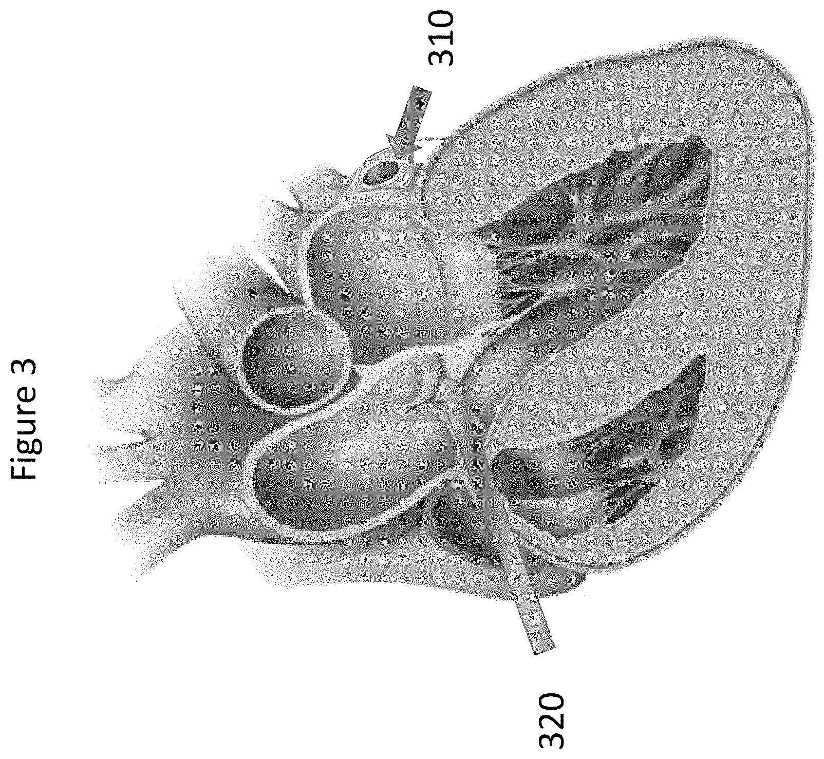 Patent US11771557 Figure 3 – Apparatus and method to reshape geometry of diseased heart valve