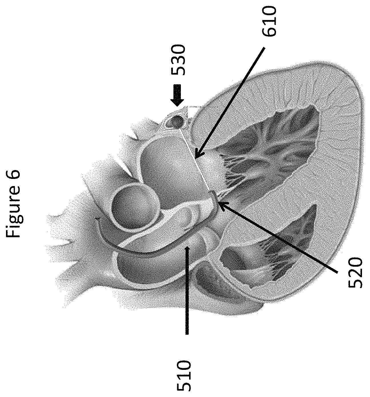 Patent US11771557 Figure 6 – Apparatus and method to reshape geometry of diseased heart valve