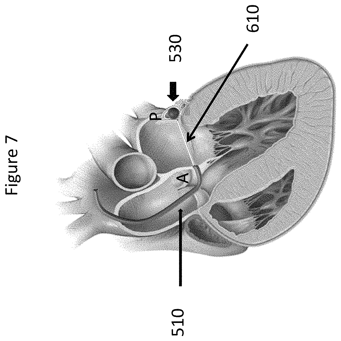 Patent US11771557 Figure 7 – Apparatus and method to reshape geometry of diseased heart valve