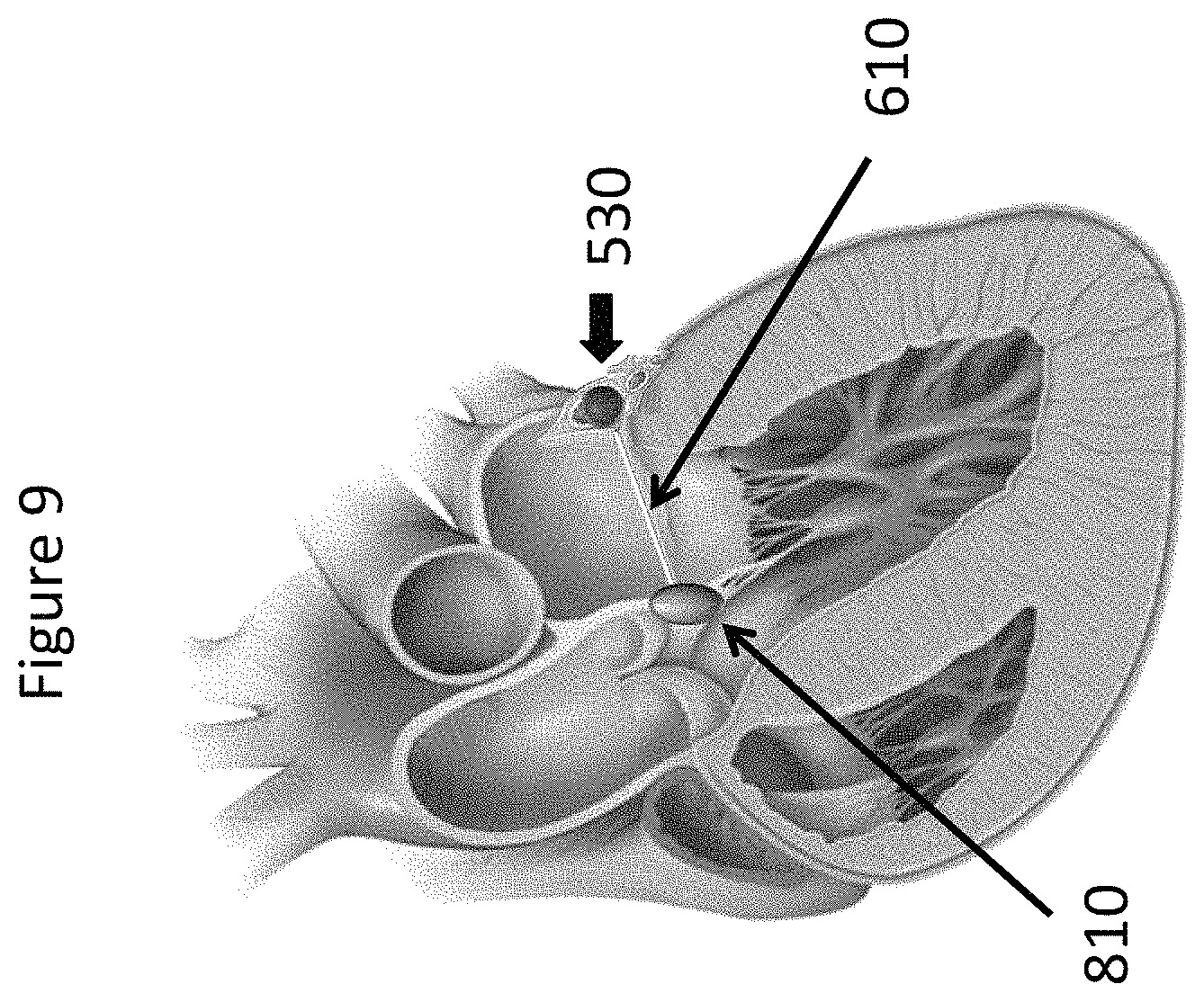 Patent US11771557 Figure 9 – Apparatus and method to reshape geometry of diseased heart valve