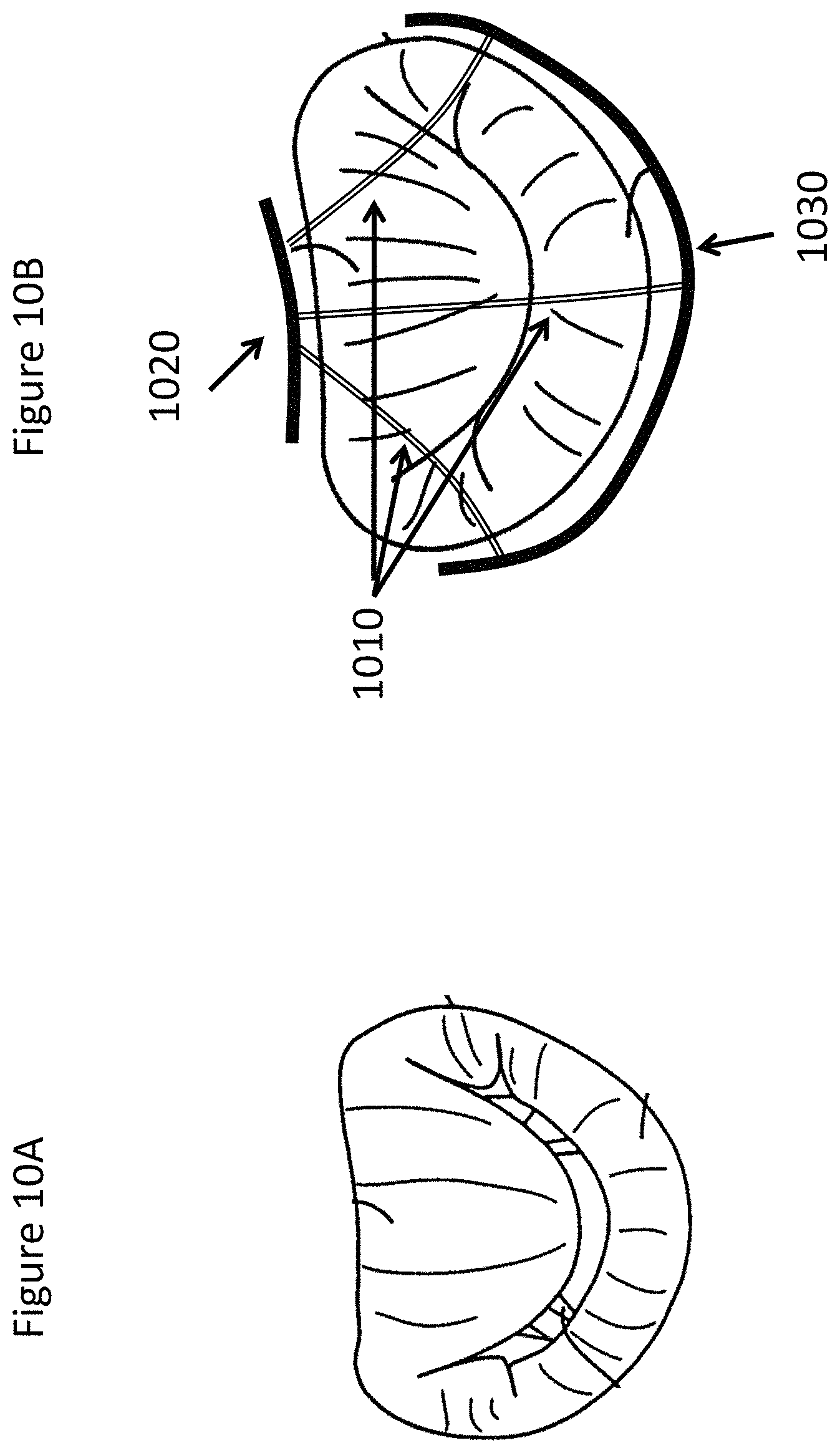 Patent US11771557 Figure 10 – Apparatus and method to reshape geometry of diseased heart valve