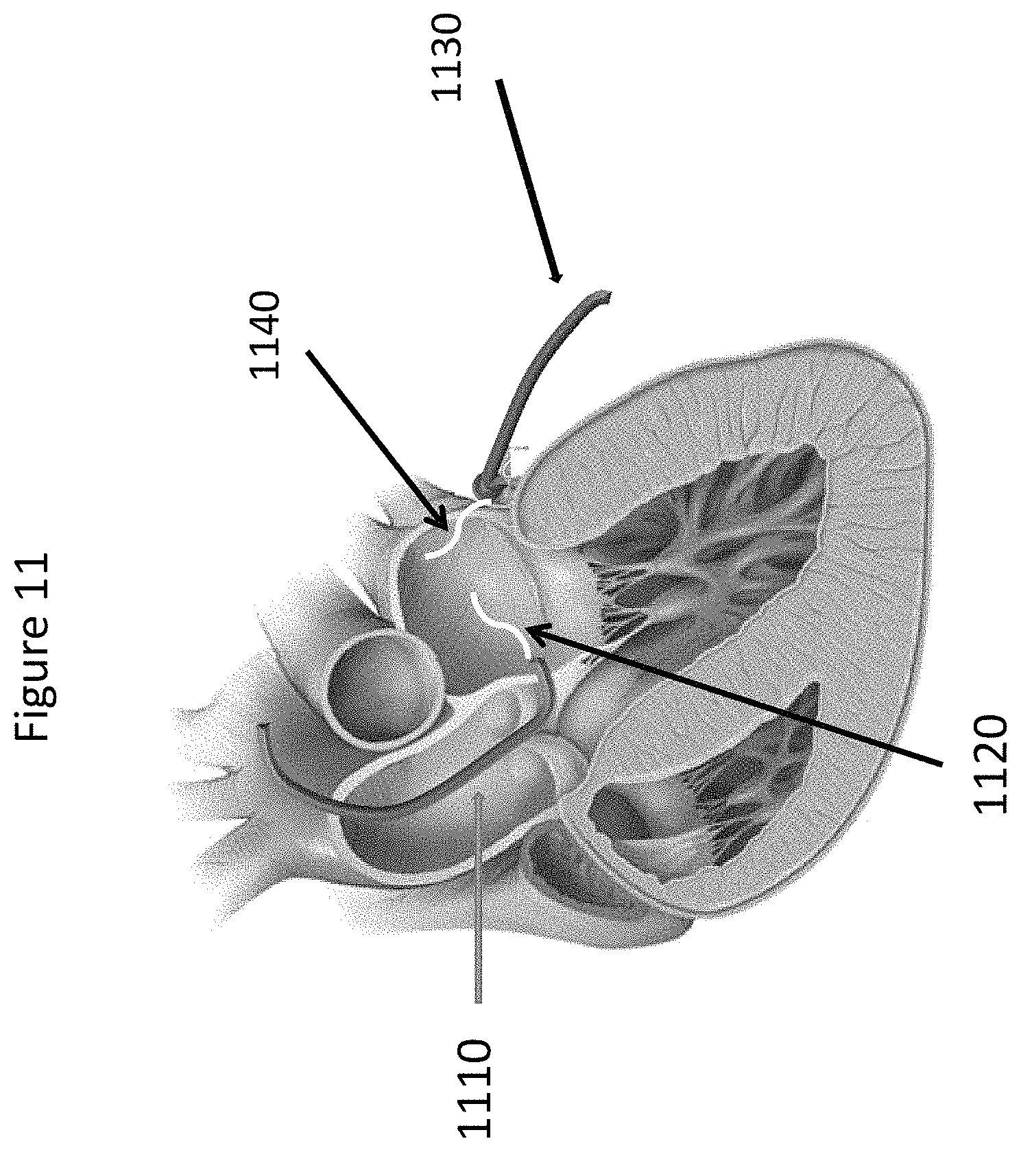 Patent US11771557 Figure 11 – Apparatus and method to reshape geometry of diseased heart valve