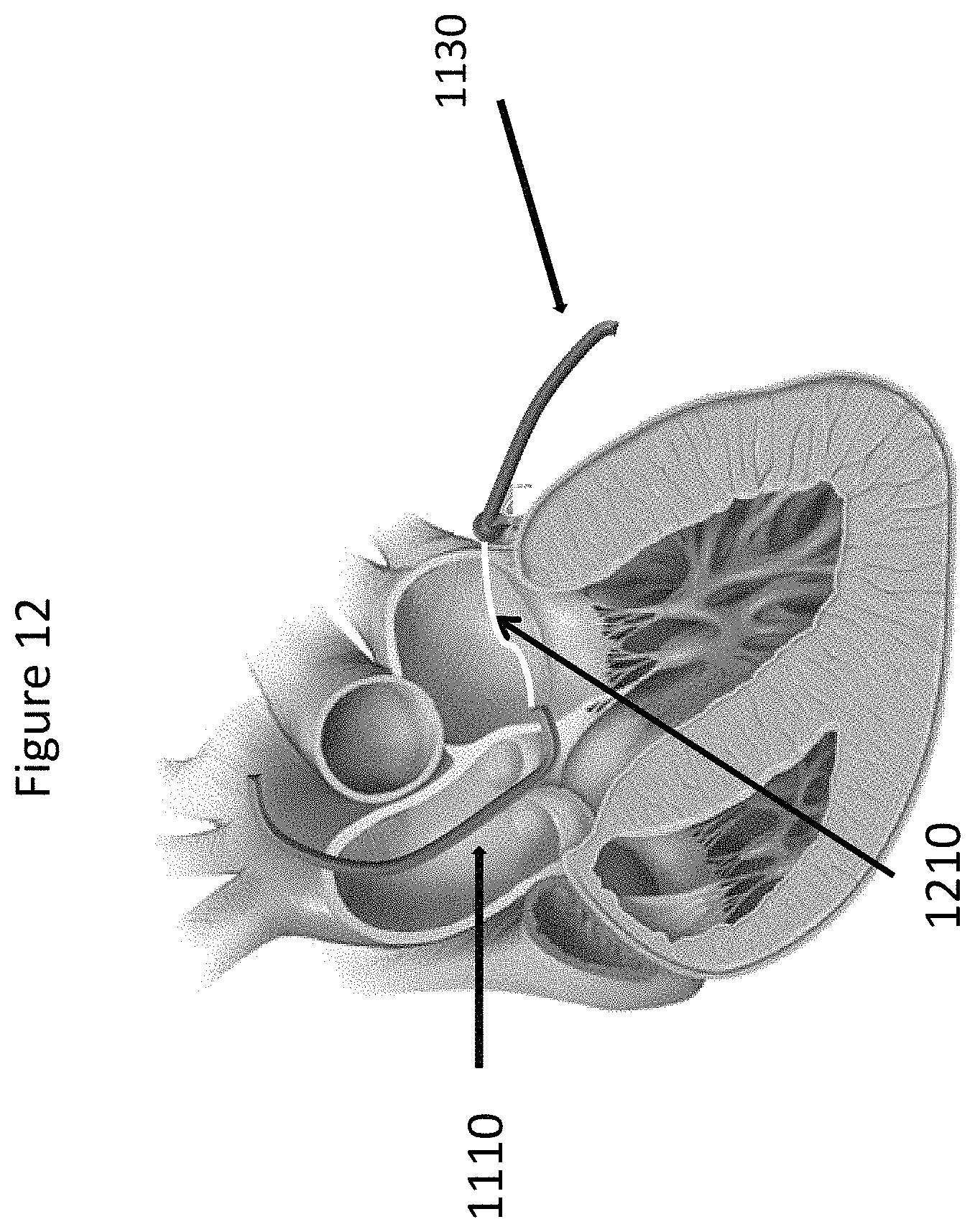 Patent US11771557 Figure 12 – Apparatus and method to reshape geometry of diseased heart valve