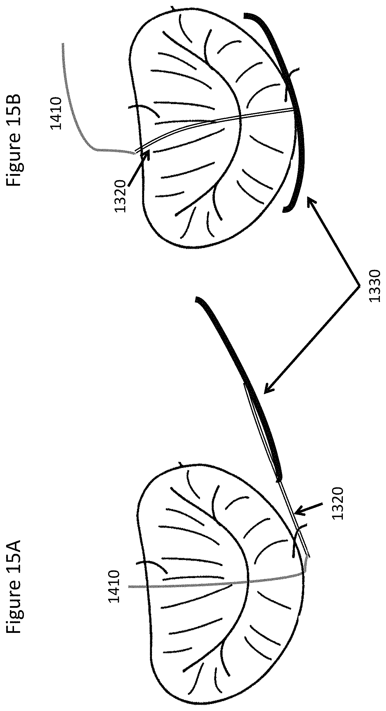 Patent US11771557 Figure 15 – Apparatus and method to reshape geometry of diseased heart valve