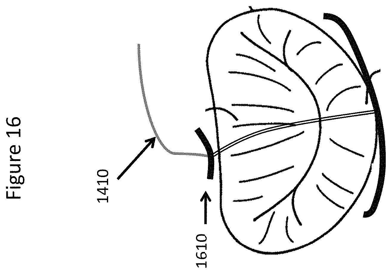 Patent US11771557 Figure 16 – Apparatus and method to reshape geometry of diseased heart valve