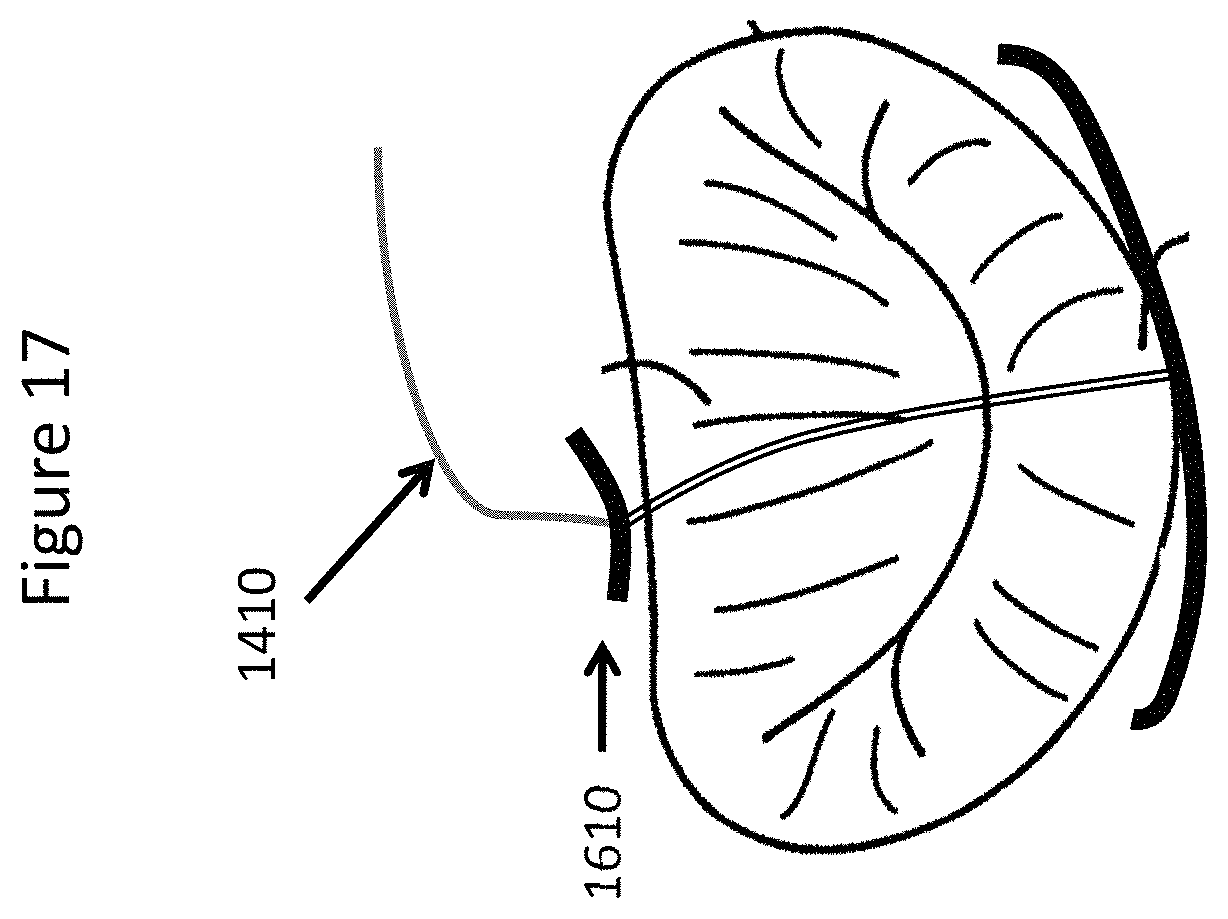 Patent US11771557 Figure 17 – Apparatus and method to reshape geometry of diseased heart valve
