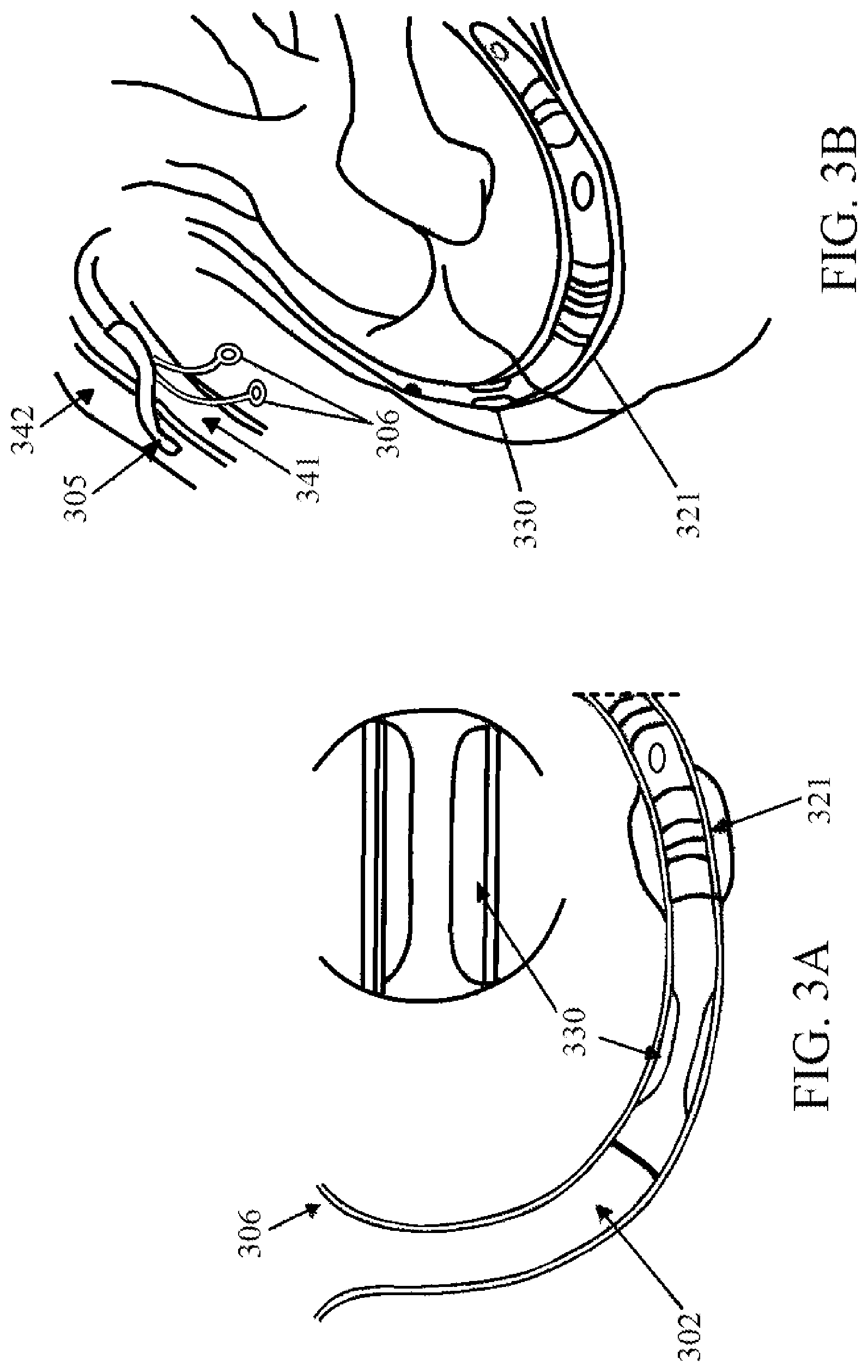 Patent US11771558 Figure 3 – Devices and methods for controlling blood perfusion pressure along with regional mild hypothermia