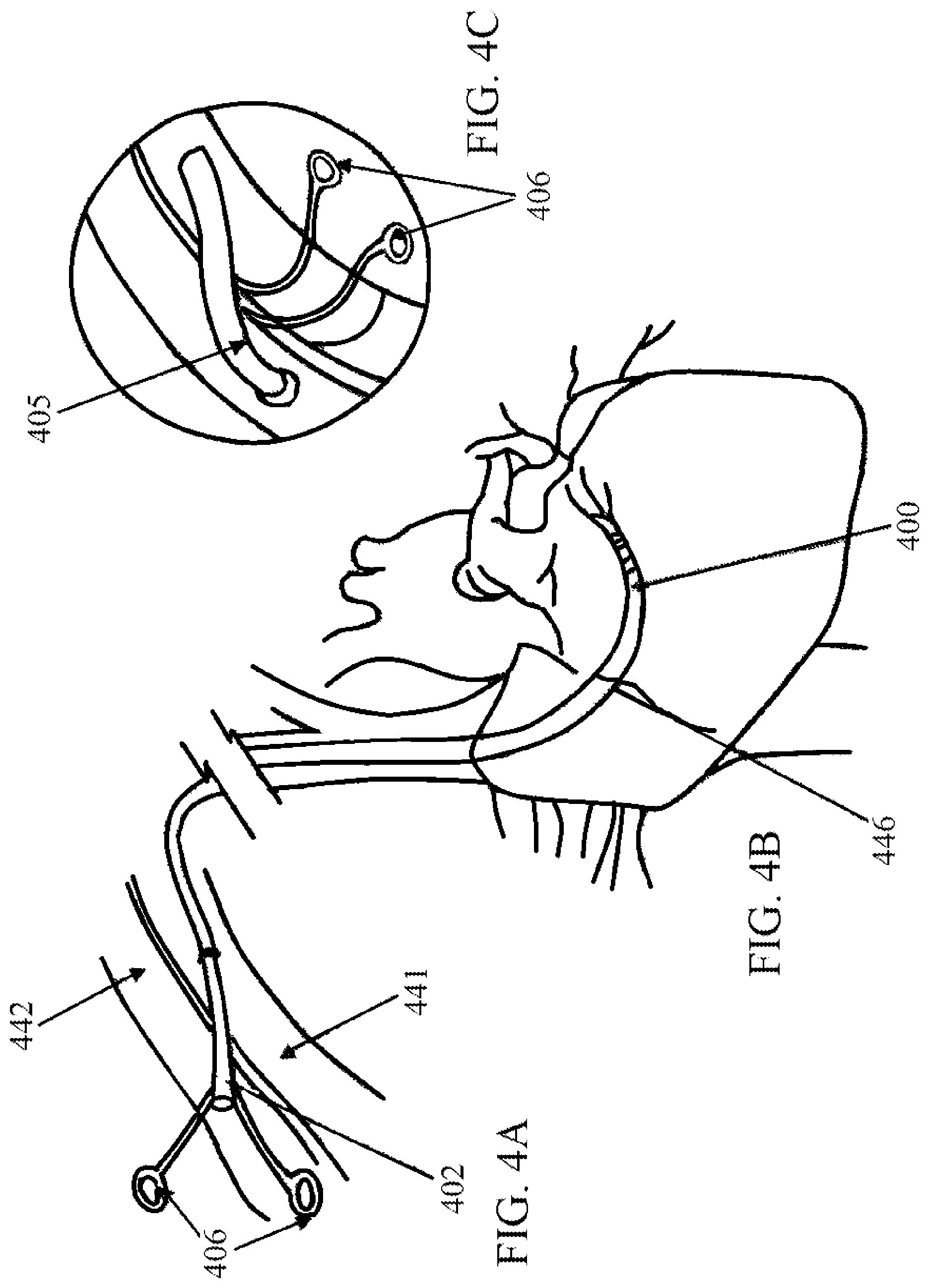 Patent US11771558 Figure 4 – Devices and methods for controlling blood perfusion pressure along with regional mild hypothermia