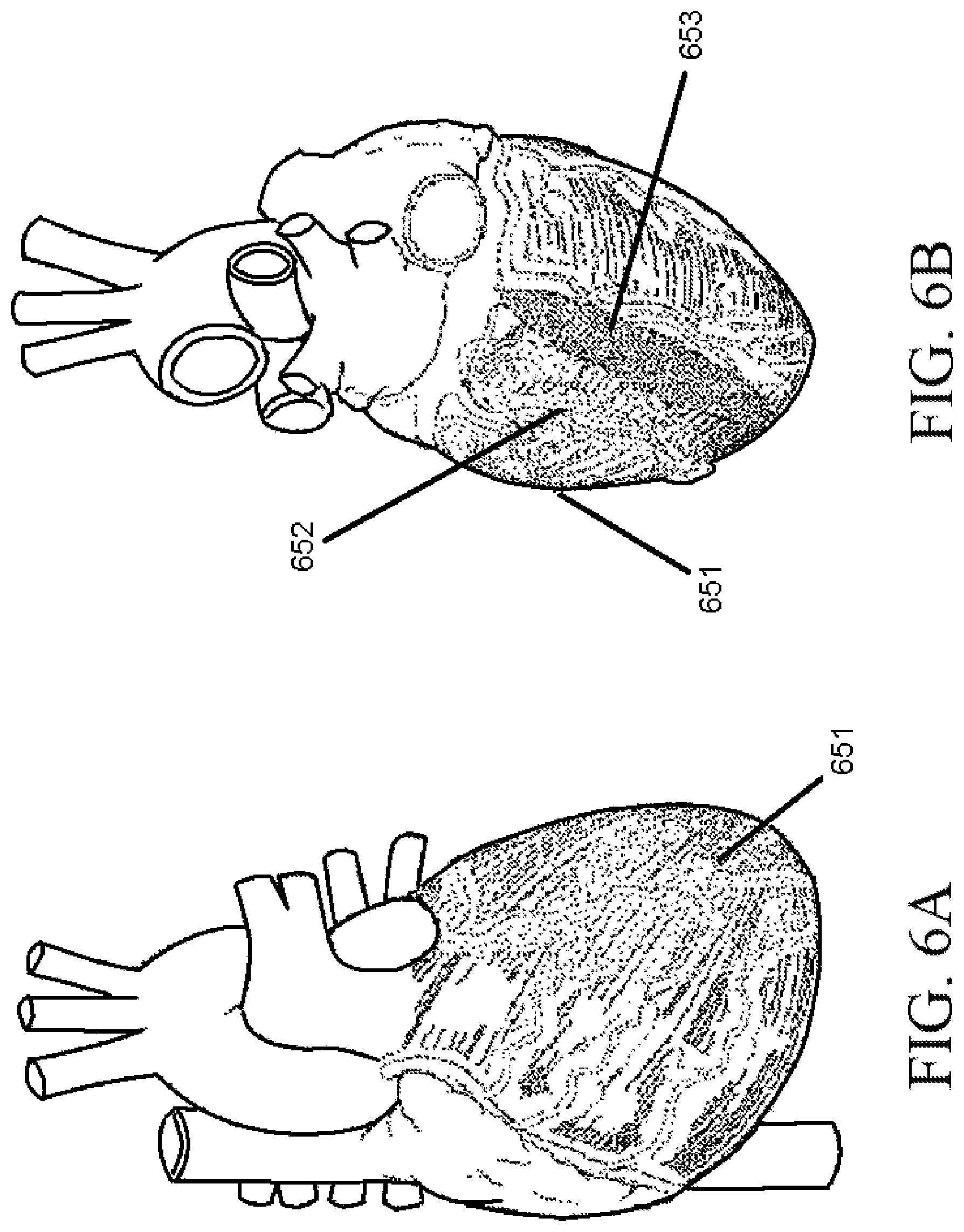 Patent US11771558 Figure 6 – Devices and methods for controlling blood perfusion pressure along with regional mild hypothermia